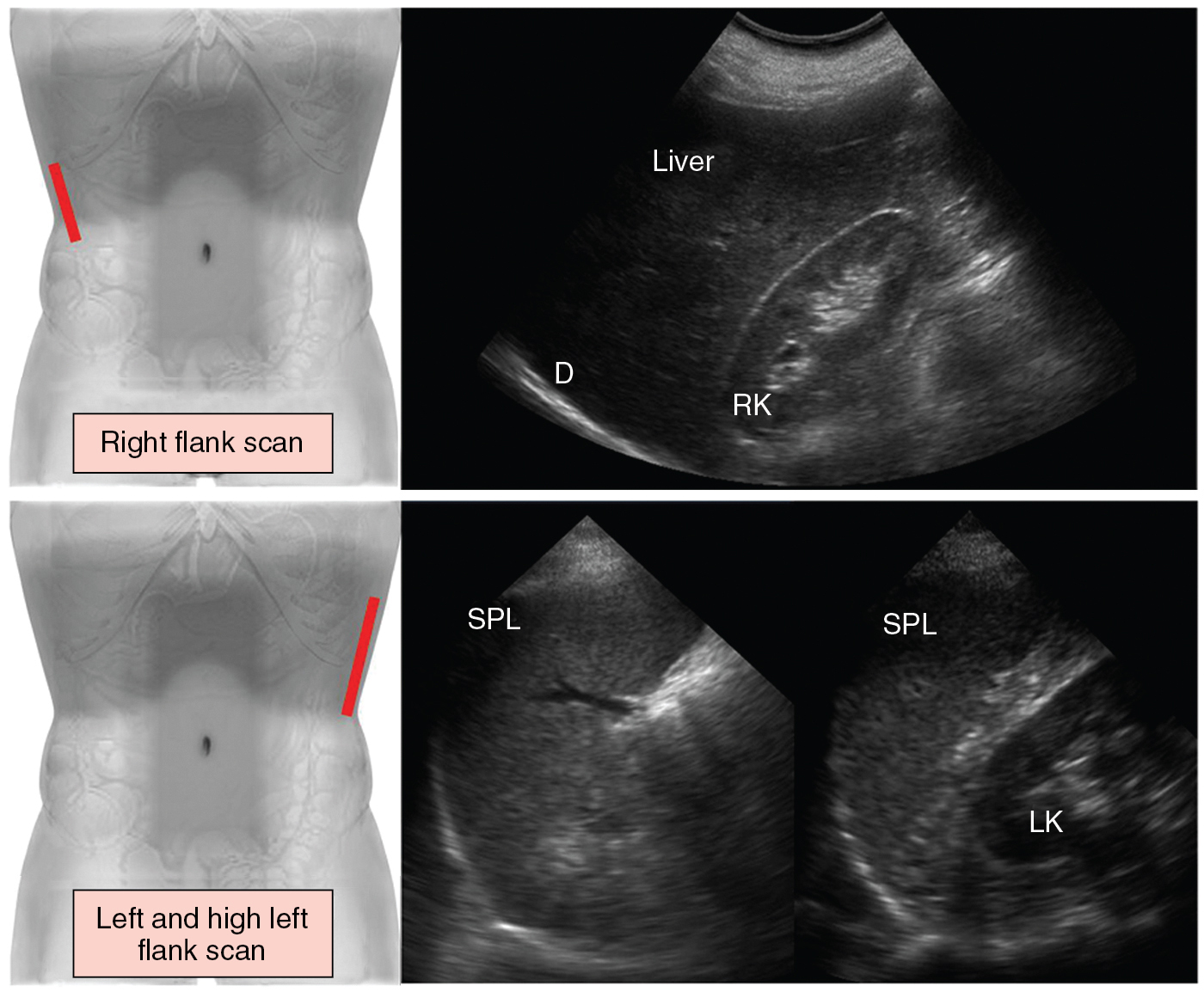 Figure 41 E-3, ( Top ) Right flank scan. The transducer is placed lateral to the midaxillary line to evaluate the pleural angle distal to the diaphragm (D), the right kidney (RK), the right liver lobe, and the hepatorenal space (Morison pouch). ( Bottom ) For left and high left flank (intercostal) scans, the transducer is placed in an intercostal space cranial to the left flank and angled cephalad to demonstrate the spleen (SPL) in longitudinal section. The length and thickness of the spleen are measured at the level of the splenic hilum ( left ). By sweeping the transducer caudally from the high flank scan, the left kidney (LK) appears in longitudinal section posterior to the spleen, and the splenorenal space can be evaluated ( right ).