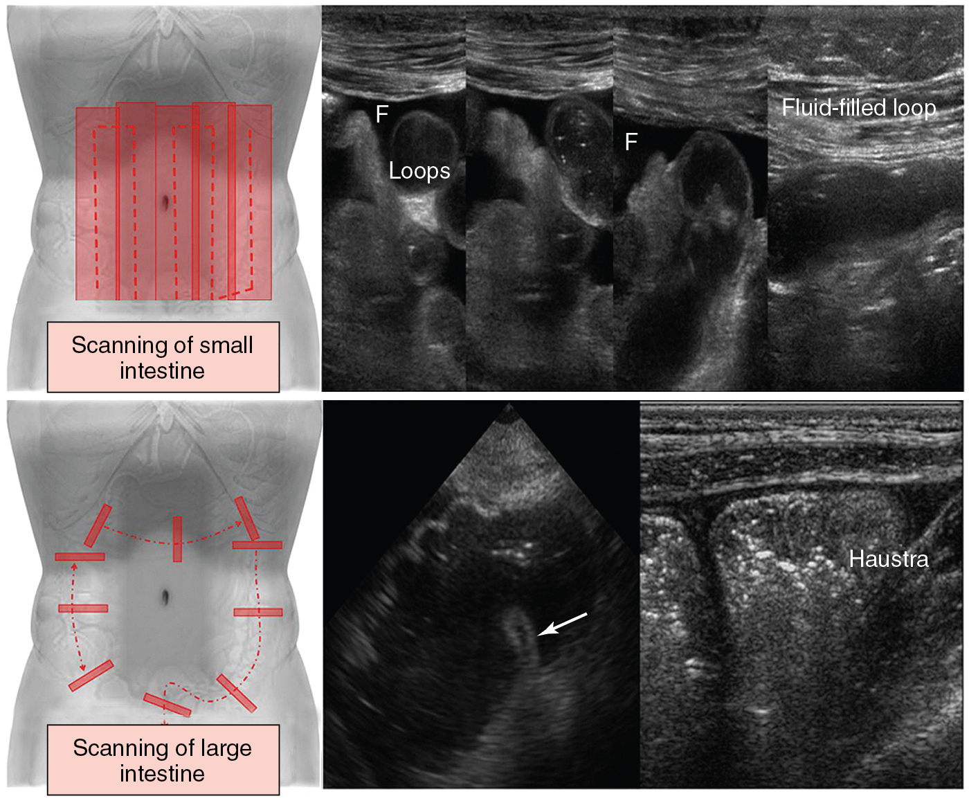 Figure 41 E-4, ( Top ) The small intestine can be examined systematically by using parallel overlapping lanes. Small intestinal loops are best visualized if intraperitoneal fluid (F) is present. ( Bottom ) Cross-sectional examination of the colon is usually performed to identify major colonic segments ( left ), such as the cecum and ileocecal valve ( arrow ), whereas scanning of the ascending colon in a longitudinal plane is used to visualize its typical haustration ( right ).