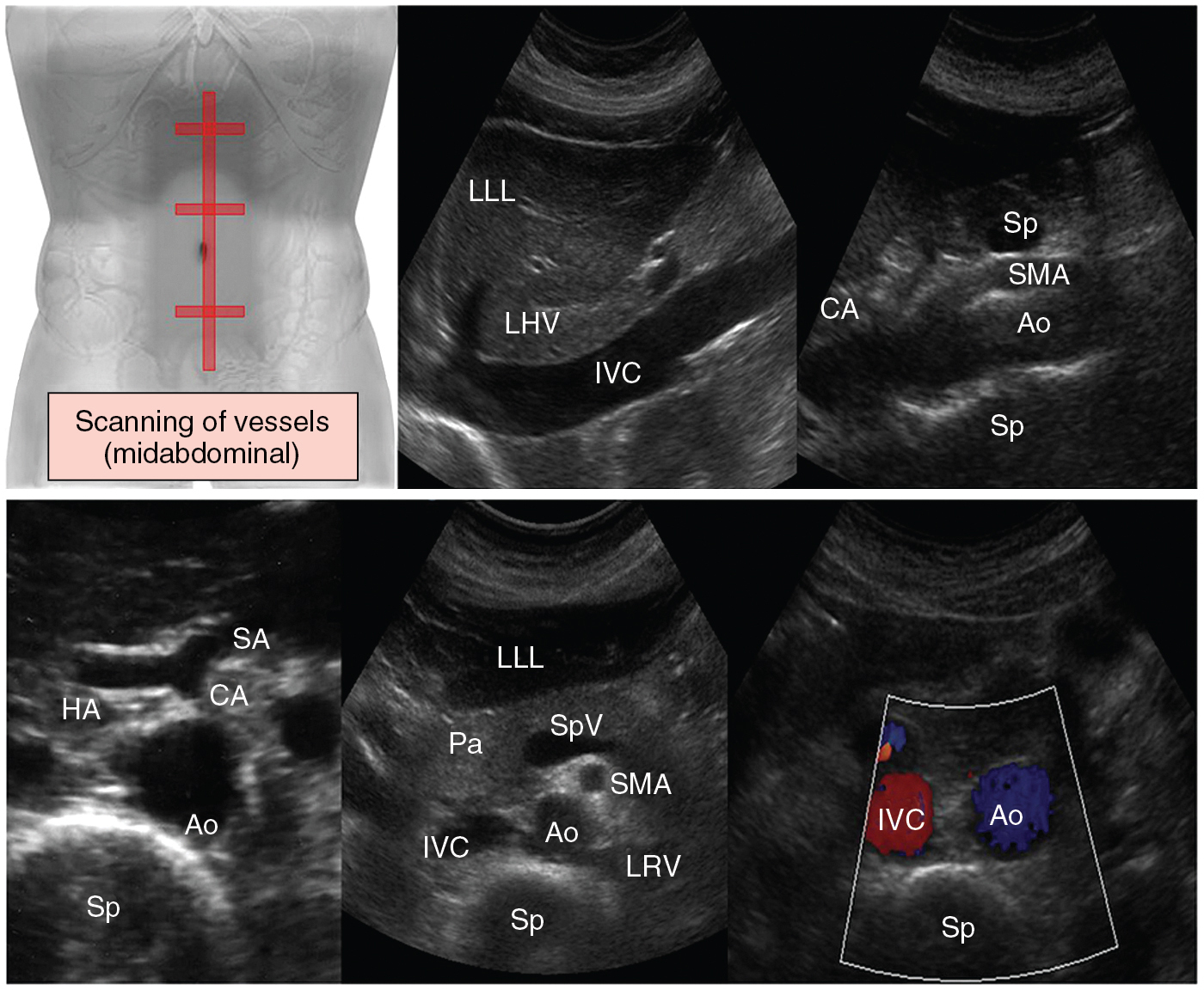 Figure 41 E-5, Standard scanning of abdominal vessels (midabdominal plane). On transverse ( top ) and longitudinal views ( bottom ) along the midline of the abdomen, the aorta, inferior vena cava, celiac axis, and superior mesenteric vessels are visualized anterior to the spine. Ao , Aorta; CA , celiac artery; HA , hepatic artery; IVC , inferior vena cava; LHV , left hepatic vein; LLL , left liver lobe; LRV , left renal vein; Pa , pancreas; SMA , superior mesenteric artery; SA , splenic artery; Sp , spine; SpV , splenic vein.