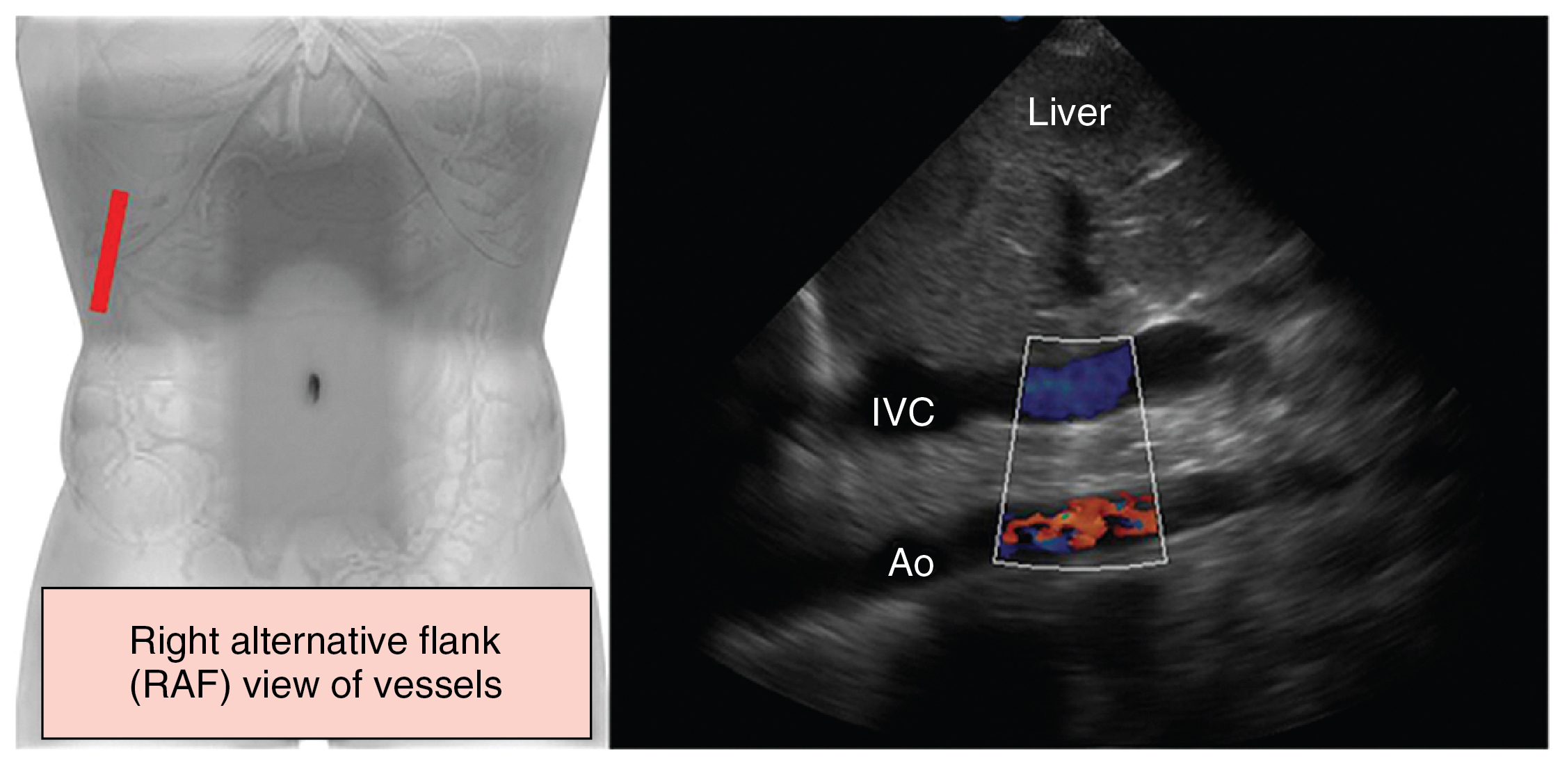 Figure 41 E-6, Alternative (flank) scanning of abdominal vessels. If midabdominal scanning is not feasible (e.g., trauma, aerocolia, surgery), major abdominal vessels can be depicted by alternative right flank views in supine patients in the intensive care unit. This view requires various adjustments of the transducer (rotating and tilting) and the scanning plane, which depends on positioning of the patient, to visualize major abdominal vessels such as the inferior vena cava (IVC) and the aorta (Ao) ( the right alternative flank [RAF] view is suggested by Dr. Karakitsos; however, further analysis is beyond the scope of this chapter).