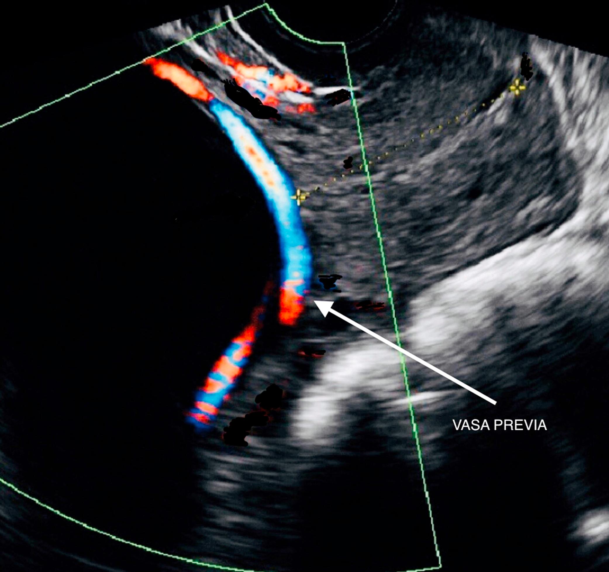 Fig. 15.2, Ultrasound image showing vasa previa.