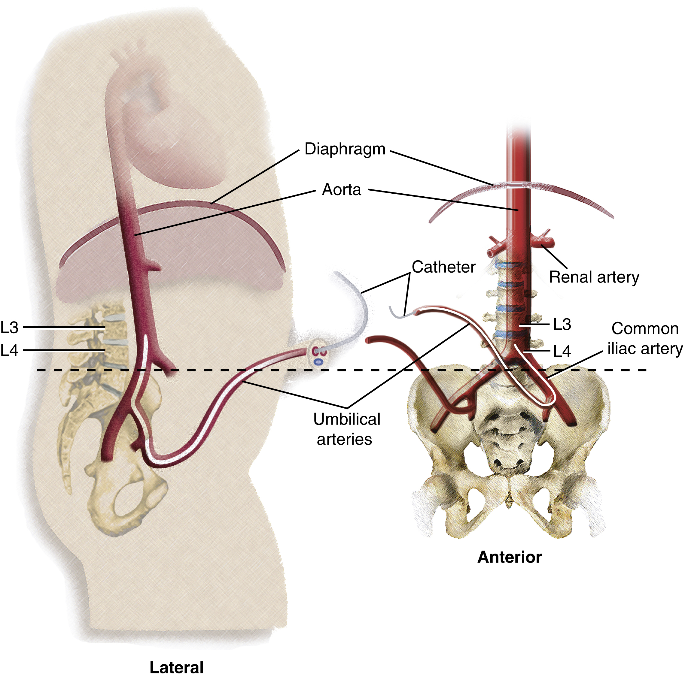 Fig. 42.2, Lateral and anterior location of abdominal aortic bifurcation with reference to L3 and visualization of umbilical arteries and common iliac arteries.