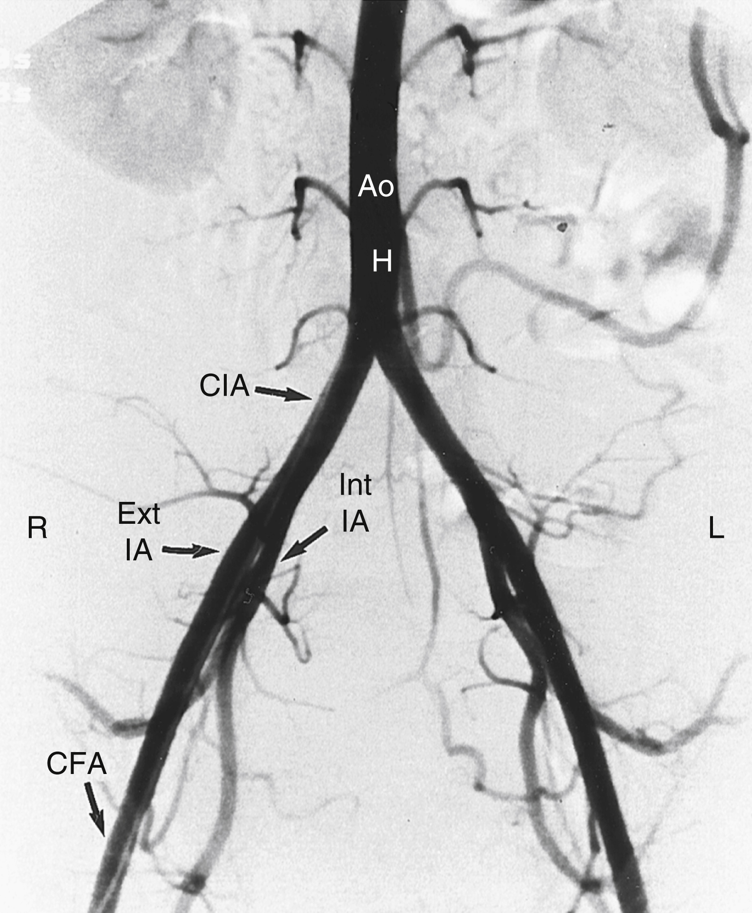 Fig. 42.3, Digital subtraction angiogram in anteroposterior projection shows distal abdominal aorta ( Ao ) with small lumbar branches, common iliac artery ( CIA ), internal and external iliac arteries ( Ext IA, Int IA ), and common femoral artery ( CFA ). L , left; R , right.