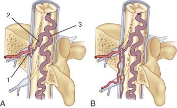 FIG. 93.11, Dural arteriovenous fistula (AVF; intradural AVF, type I spinal arteriovenous malformation [AVM]). (A and B) A single location and single arterial feeder (type IA) and multiple dural arterial supply (type IB): 1, dural branches of radicular artery supplying AVM within the dura; 2, arterialized radiculomedullary vein; 3, dilated posterior median vein. (C) Intraoperative image of a dural AVF after opening of the dura shows an arterialized and congested posterior median vein ( arrow ) and a markedly swollen spinal cord. (D) Contrast medium–enhanced T1-weighted magnetic resonance (MR) image shows a nonspecific, diffuse, flame-shaped enhancement and swelling of the spinal cord ( curved arrow ) and dilated posterior median vein ( arrow ). (E) Three-dimensional time-of-flight MR angiogram in the coronal plane shows congested radiculomedullary vein ( single arrow ) and dorsal median vein ( double arrows ). (F) A microcatheter has been navigated through an intercostal artery ( arrowheads ), and superselective angiography of the radicular artery ( long arrow ) delineates the dural AVF ( curved arrow ), the retrograde draining and congested radiculomedullary vein ( double arrows ), and the congested dorsal median vein ( large arrow ). (G) After embolization, a plain spine radiograph shows N -butyl-cyanoacrylate cast within the radicular artery ( arrow ), the point of fistulization ( curved arrow ), and the radiculomedullary vein ( double arrows ). (H) Control angiography of the intercostal artery ( arrow ) shows a complete dural AVF obliteration.