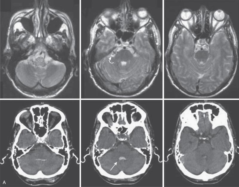 FIG. 93.12, A 55-year-old neurologically intact man presented with an intraventricular hemorrhage associated with a tentorial dural arteriovenous shunt (AVS) with drainage into the congested spinal venous system. (A) Axial T2-weighted magnetic resonance images and computed tomographic scans show hemorrhage into the fourth ventricle ( arrow ) and abnormal vascular structure anterior to the cerebellopontine angle ( curved arrow ). (B) Right internal and external carotid artery angiograms show dural branches originating from the meningohypophyseal trunk and the middle meningeal artery ( double arrows ) with filling of a tentorial dural AVS ( curved arrows ). Note early retrograde filling of congested median anterior pontine vein, transverse pontine vein, lateral pontine vein, and posterior and anterior median medullary veins ( single arrows ). (C) Left vertebral artery injection shows additional supply of the AVS via the tentorial branch (artery of Davidoff and Schechter) originating from the right superior cerebellar artery and early venous drainage into the spinal canal ( arrows ); an associated superior cerebellar artery aneurysm is seen ( curved arrow ). (D) Three-dimensional angiography and superselective injection of the right superior cerebellar artery ( double arrows ) proximal to the aneurysm ( single arrows ) show the tentorial AVS ( large arrow ) fed by dural artery ( curved arrows ), the tentorial malformation, and the early filling of congested median anterior pontine vein ( arrowhead ). (E) Catheterization of dural artery through the aneurysm ( white arrow ) and filling of the AVS ( large arrow ) and tentorial dural veins ( arrowheads ). Note early venous drainage into the spinal canal ( single arrows ). (F) N -butyl cyanoacrylate infusion with filling of the AVS nidus ( curved arrow ), dural veins ( arrows ), and retrograde dural arteries originating from the internal carotid artery ( arrowhead ). Coiling of the superior cerebellar artery aneurysm ( large arrow ) in the same session. (G) Control injection of the common carotid artery and the vertebral artery shows complete obliteration of the dural malformation and no filling of the meningohypophyseal dural branches ( single arrow ) and the aneurysms ( double arrows , coil artifact superimposed on the superior cerebellar artery). Note the patency of the artery ( curved arrow ).