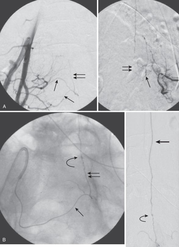 FIG. 93.13, Sacral dural arteriovenous shunt in a 60-year-old man who presented with paraparesis and bowel and bladder dysfunction. (A) Right internal iliac artery angiogram shows lateral sacral arteries ( arrows ) filling the dural artery of the filum ( double arrows ). (B) Superselective angiogram through the lateral sacral artery shows the spinal dural arteriovenous fistula within the end of the thecal sac ( curved arrow ) and the ascending vein along the cauda equina ( thick arrow ).