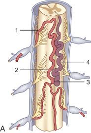 FIG. 93.14, Pial arteriovenous shunt (AVS; ventral intradural AVF or type IV spinal arteriovenous malformation). (A) Schematic illustration: 1, radiculomedullary artery; 2, anterior spinal artery; 3, arteriovenous fistula; 4, arterialized and congested anterior median vein. (B) Sagittal T2-weighted MR images show prominent intradural vessels ventral and dorsal to the conus ( arrows ). (C) Lumbar artery injection shows an enlarged radiculomedullary artery ( arrowheads ) and anterior spinal artery ( single arrow ) and an arteriovenous shunt ( curved arrow ) with early venous drainage ( double arrows ). (D) Congested ventral and dorsal veins as well as the venous plexus at the conus level ( arrows ). (E) Microcatheter angiography of the anterior spinal artery before embolization with N -butyl cyanoacrylate shows the congested venous system. (F) Two-year follow-up angiography after embolization shows a persistent AVS obliteration and patency of the anterior spinal artery ( arrow ).