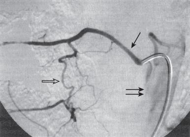 FIG. 93.2, Selective intercostal artery injection ( single arrow ) shows a longitudinal pretransverse anastomosis ( open arrow ) between the arteries of adjacent segments. Note reflux of contrast agent into the abdominal aorta ( double arrows ).