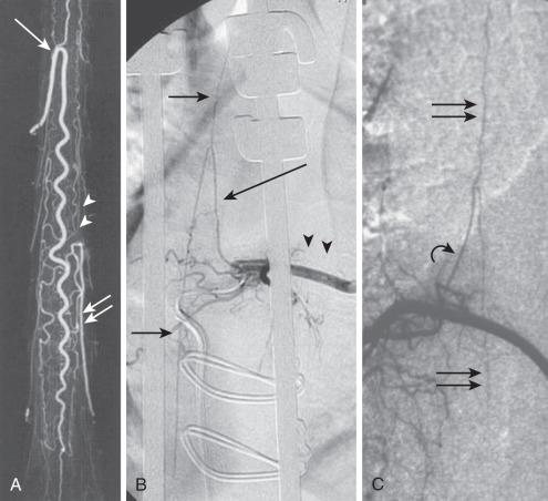 FIG. 93.3, (A) Microradiograph of the spinal cord vasculature shows the typical hairpin anastomosis between the radiculomedullary artery (artery of Adamkiewicz) and the anterior spinal artery ( single arrow ) found at the lower thoracic and the upper lumbar levels. A large radiculopial artery is seen ( double arrow ) with supply to the posterior spinal artery ( arrowheads ). (B) Left T10-intercostal arteriogram ( arrowheads ) shows the radiculomedullary artery ( long arrow ) and the anterior spinal artery ( short arrows ). (C) Injection of an intercostal artery shows a radiculopial artery ( curved arrow ) and the right posterior spinal artery (double arrows); note the smaller radius of the hairpin shape.