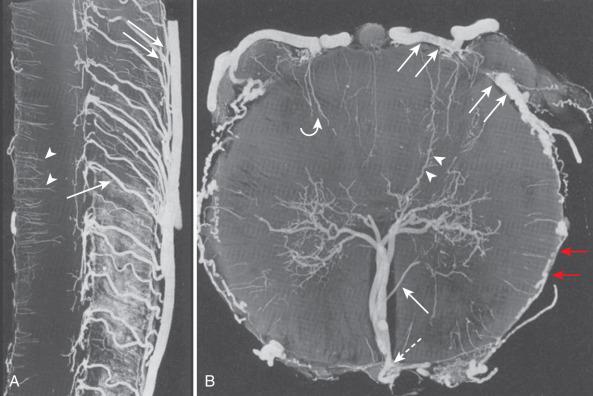 FIG. 93.4, Microradiographs of injected spinal cord vasculature. (A) Midsagittal plane shows ascending sulcocommissural arteries ( single arrow ) within the ventral sulcus of the spinal cord originating from the anterior spinal artery ( double arrows ) and dorsal perforators originating from posterior spinal arteries ( arrowheads ). (B) Axial plane shows the sulcocommissural artery and anterior perforators that supply the gray matter ( single arrow ). Intramedullary anastomoses between anterior and posterior perforators ( arrowheads ); posterior pial network and posterior spinal arteries ( double arrows ); superficial pial anastomoses between the anterior and posterior spinal arteries ( red arrows ); anterior spinal artery ( dashed arrow ); lateral perforators to white matter originating from pial network ( curved arrow ).