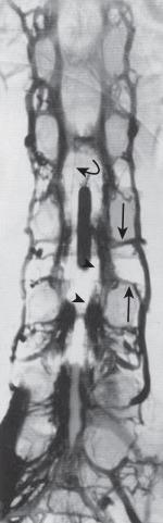 FIG. 93.8, Venography of lumbosacral epidural venous plexus. The emissary radicular veins ( arrows ) connect the epidural venous plexus ( arrowheads ) with the longitudinal paravertebral efferent system. Reflux is seen in the radiculomedullary vein ( curved arrow ).