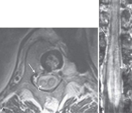 FIG. 93.9, A 50-year-old patient presented with paraparesis. Pial arteriovenous malformation (AVM) is associated with a split cord malformation type II (diastematomyelia). (A) Axial and (B) coronal magnetic resonance images show the split cord ( curved arrow ) and some enlarged vasculature ( arrows ). A significant cord swelling and edema is seen. (C) Superselective injection of the artery of Adamkiewicz ( arrowhead ) and three-dimensional rotational angiography (D and E) show the pial AVM, the typical hairpin turn of the anterior spinal artery ( large arrows ), and apically directed drainage into two main arterialized and congested dorsolaterally located longitudinal veins ( arrows ).