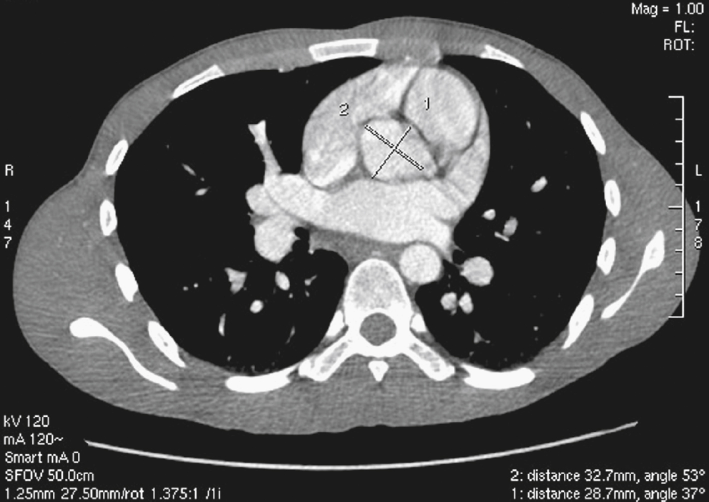 Fig. 50.1, Contrast-enhanced axial computed tomography image of chest of young man, just above aortic valves. Ascending aorta is central in the heart, slightly to left of midline in this case. It is oval and has a long-axis diameter of 33 mm. Ostium of left coronary artery is just visible at one end of caliper 2. Patient had no history or clinical features of cardiac disease.