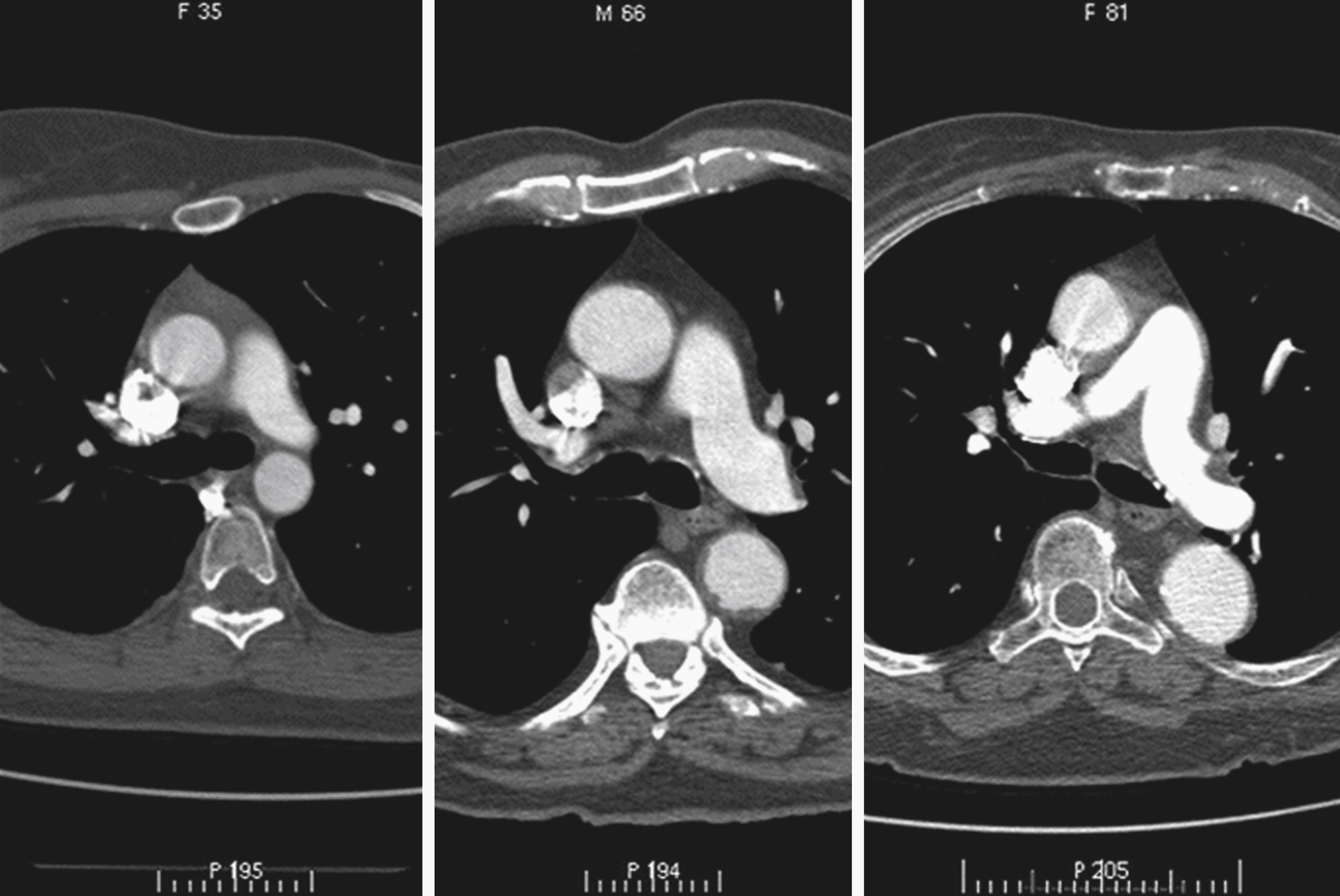 Fig. 50.10, Contrast-enhanced axial computed tomography images of chest of a young woman ( left ), an older man ( middle ), and an elderly woman ( right ) at level of carina. Note differences in position of descending aorta relative to vertebral body, and diameter of ascending aorta relative to descending aorta (which is aneurysmal in elderly patient on right).