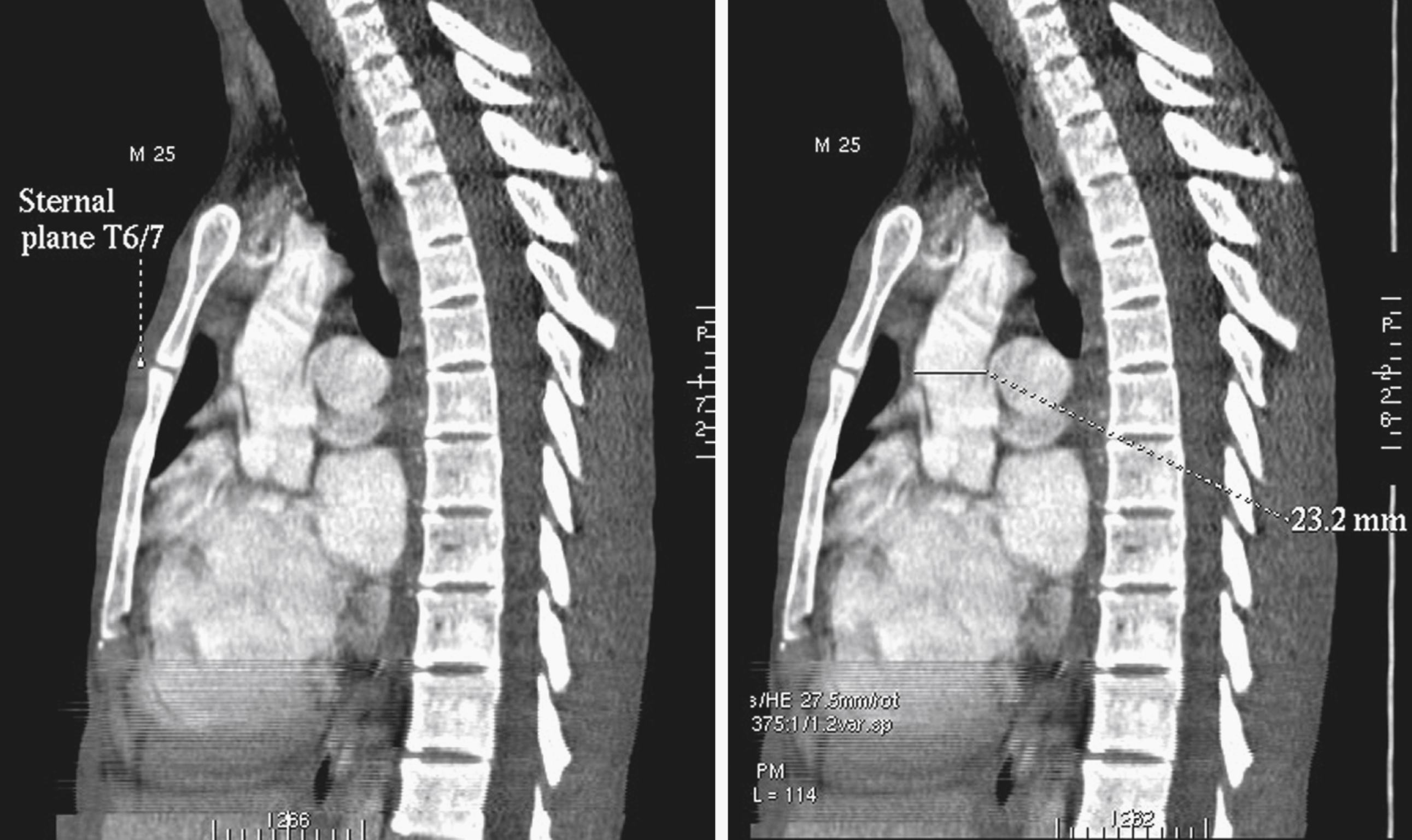 Fig. 50.11, Sternal plane in this young man lies at T6/T7 disk level and cuts through pulmonary trunk bifurcation rather than aortopulmonary window (note his unusually tall vertebral bodies). Arch apex rises almost to top of manubrium (see also Fig. 50.12 ). “Jagged” appearance of ascending aorta is a pulsation artifact.