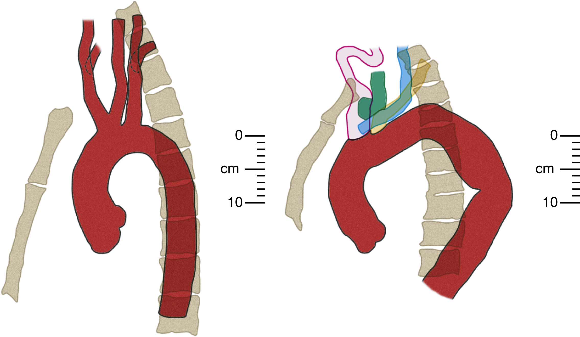 Fig. 50.12, Left anterior oblique “catheter angiogram” arch views reconstructed from computed tomography scans. Left image is drawn from young man in Fig. 50.10 , and right image from an 81-year-old woman. Note common origin of brachiocephalic trunk and left common carotid artery in both patients, unusually low origin of right common carotid artery in elderly woman, different relative positions of branch origins to sternal plane and arch apex, and striking difference between the two patients in vessel tortuosity and arch curvature, length, and height.