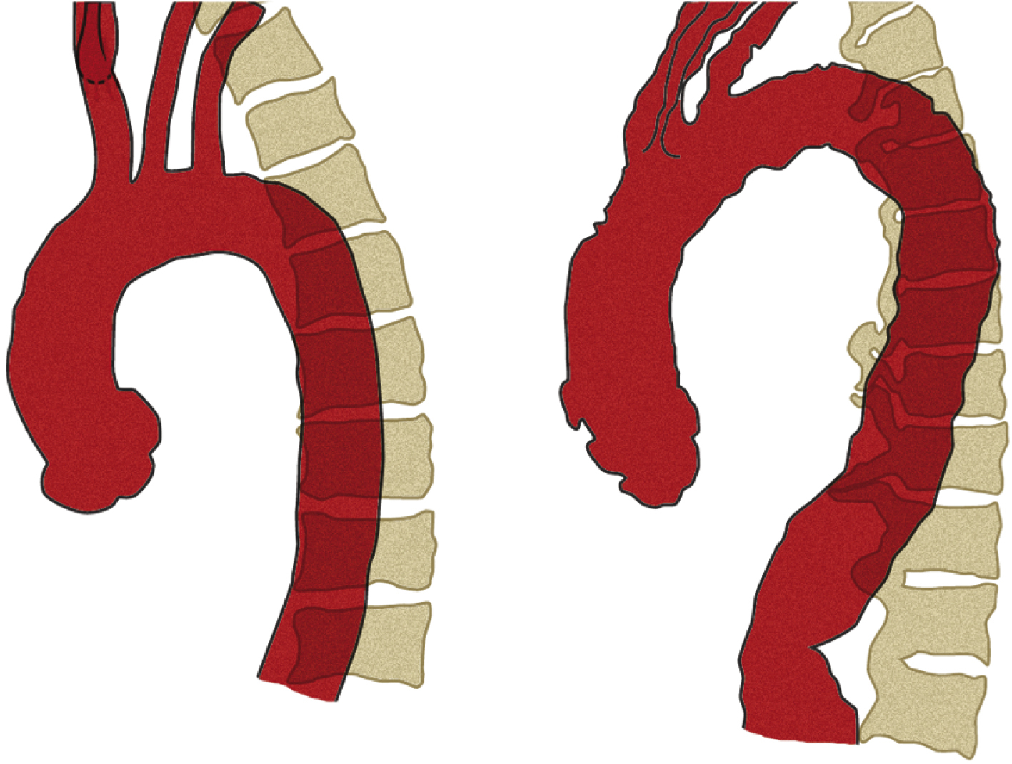 Fig. 50.13, Left anterior oblique “catheter angiogram” arch views reconstructed from computed tomography scans. In left image from a 35-year-old woman, arch branches arise at same axial (horizontal) level, perpendicular to apex of arch. In right image from a 78-year-old man, aorta is elongated, with a “new” and higher apex caudal to arch branches such that their origins are on a slope. This elongation also “pushes” origins of great vessels anteriorly (compare their distances from vertebral column with those in younger patient). Because their destinations at thoracic inlet remain fixed, these changes result in arteries being “bent backward” on the arch.