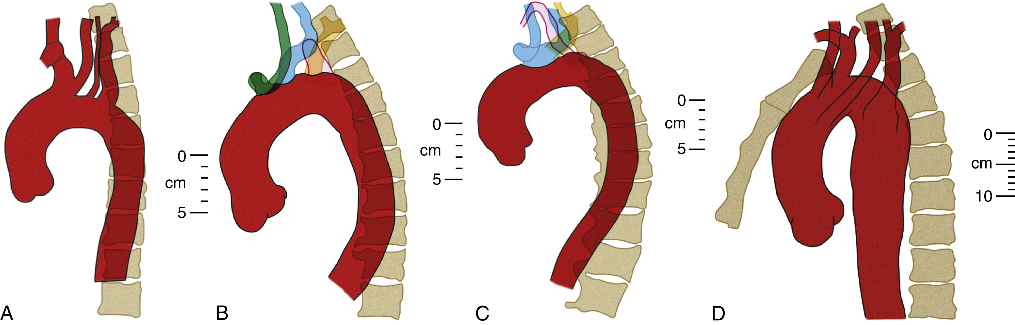 Fig. 50.14, (A) Left anterior oblique “catheter angiogram” arch view reconstructed from computed tomography (CT) scan. This 23-year-old man has a common origin of brachiocephalic trunk and left common carotid artery, as well as a direct arch origin for left vertebral artery. Note similar level of origin for all three arch branches at apex. (B) Left anterior oblique catheter angiogram arch view reconstructed from CT scan. This 68-year-old man has direct arch origins for both right and left common carotid and subclavian arteries. Right subclavian artery arises as fourth branch just distal to left subclavian artery and passes behind esophagus. Note infundibular origin of retroesophageal right subclavian artery, almost 20 mm in diameter, which is commonly seen with this configuration. (C) Left anterior oblique catheter angiogram arch view reconstructed from CT scan. In this 84-year-old woman, a common origin gives rise to right and left common carotid and left subclavian arteries. Right subclavian artery arises distal to this trunk and is retroesophageal; again, note its infundibular origin, measuring about 15 mm in diameter in this case. (D) Left anterior oblique catheter angiogram arch view reconstructed from CT scan. In this unusual configuration in a 49-year-old man, there is a right-sided aortic arch with levocardia and a retroesophageal left subclavian artery. Isolated left common carotid artery is the first and lowest branch and arises from left wall of aorta, rather than its convexity, 3 cm below manubriosternal junction. Right common carotid and subclavian arteries arise next and mirror their “standard” left counterparts. Retroesophageal left subclavian artery arises from a dome-shaped aneurysmal infundibulum 5 cm in diameter. (Distances and dimensions were measured from source CT images.)