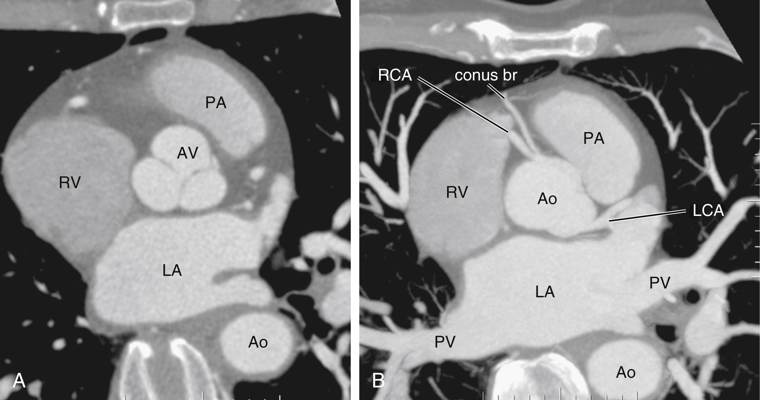 Fig. 50.2, (A) Axial image of a gated computed tomography (CT) scan of heart, showing three aortic sinuses (sinuses of Valsalva). (B) Thick slab of maximal intensity projection CT coronary angiography showing origins of right coronary artery ( RCA ) and left coronary artery ( LCA ). Conus branch ( conus br ) of RCA shares same origin of its parental artery RCA. Ao, Aorta; AV, aortic valve; LA, left atrium; PA, pulmonary artery; PV, pulmonary vein; RV, right ventricle.