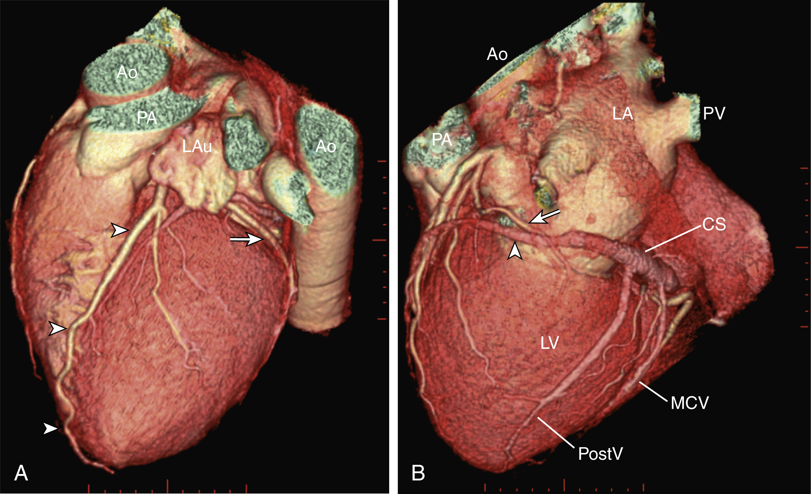 Fig. 50.3, (A) Three-dimensional (3D) volume-rendered computed tomography (CT) coronary angiography image showing branches of left coronary artery, left anterior descending artery ( three horizontal white arrowheads on left ), and left circumflex artery ( arrow ). (B) 3D volume-rendered CT coronary angiography image showing course of left circumflex artery ( long horizontal arrow ) and great cardiac vein ( vertical arrowhead ), which continues on as coronary sinus ( CS ). CS receives tributaries from posterior vein ( PostV ) of left ventricle and middle cardiac vein ( MCV ). Ao, Aorta; LA, left atrium; LAu, left auricle; PA, pulmonary artery; PV, pulmonary vein.