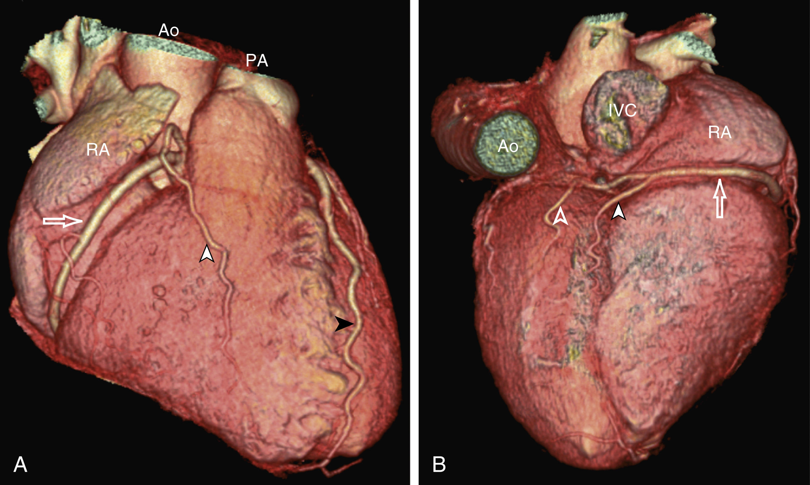 Fig. 50.4, (A) Three-dimensional (3D) volume-rendered image showing right coronary artery ( open arrow ) and its conus branch ( white arrowhead ) and a small marginal branch. Black arrowhead points to left anterior descending artery. (B) 3D volume-rendered image showing posterior aspect of heart and course of right coronary artery ( RCA ) ( open arrow ) and its terminal branches, posterior descending artery ( white arrowhead ), and posterolateral branch of RCA ( open arrowhead ). Ao, Aorta; IVC, inferior vena cava; PA, pulmonary artery; RA, right atrium.