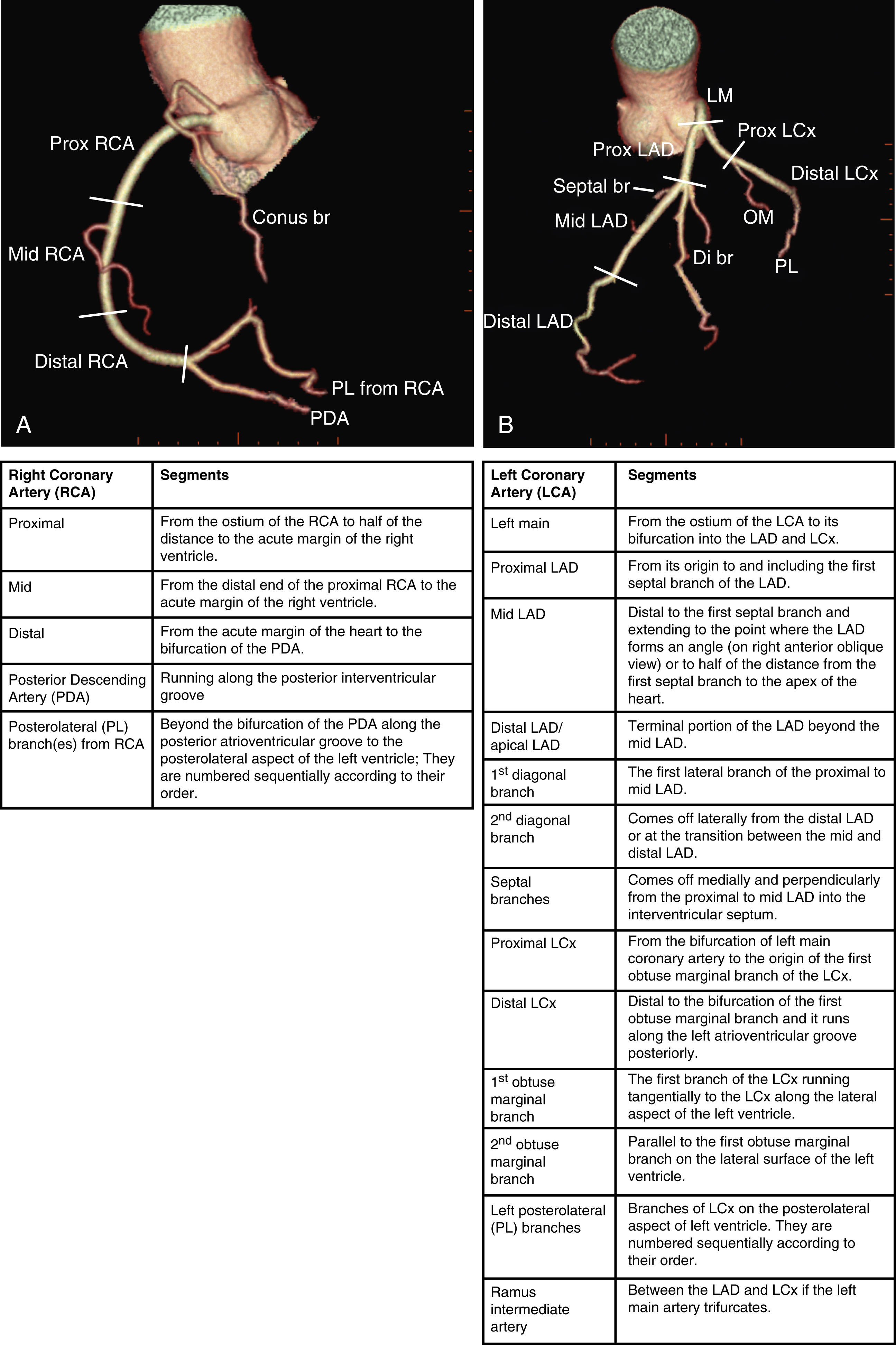 Fig. 50.5, (A) Three-dimensional (3D) volume-rendered coronary tree of right coronary artery ( RCA ), showing segments of RCA and its branches. (B) 3D volume-rendered coronary tree of left anterior descending ( LAD ) artery. br, Branch; Di br, diagonal branch; LCx, left circumflex artery; LM, left main; OM, obtuse marginal; PDA, posterior descending artery; PL, posterolateral; Prox, proximal.