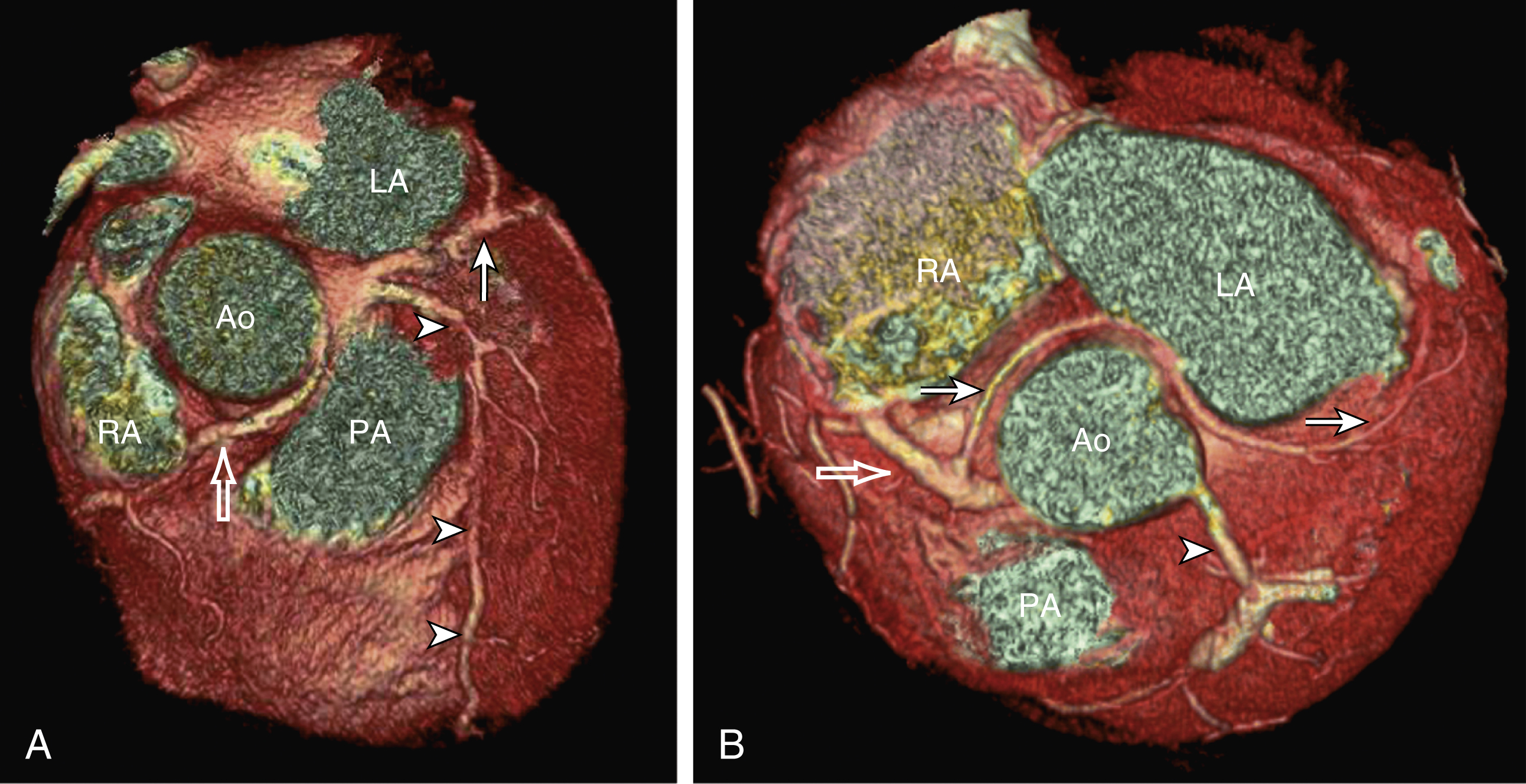 Fig. 50.6, (A) Superior view of three-dimensional (3D) volume-rendered image showing an anomalous right coronary artery (RCA) ( open arrow ) with an interarterial course between aorta ( Ao ) and pulmonary artery ( PA ). Left anterior descending (LAD) ( arrowheads ) and left circumflex (LCx) arteries ( solid arrow ) have separate origins at left coronary sinus. (B) Superior view of 3D volume-rendered image showing an anomalous LCx ( solid arrows ) with a benign course. Anomalous LCx originates from RCA ( open arrow ) and courses posterior to aorta before resuming its normal path down in left atrioventricular groove. Arrowhead points to LAD. Ao, Aorta; LA, left atrium; PA, pulmonary artery; RA, right atrium.