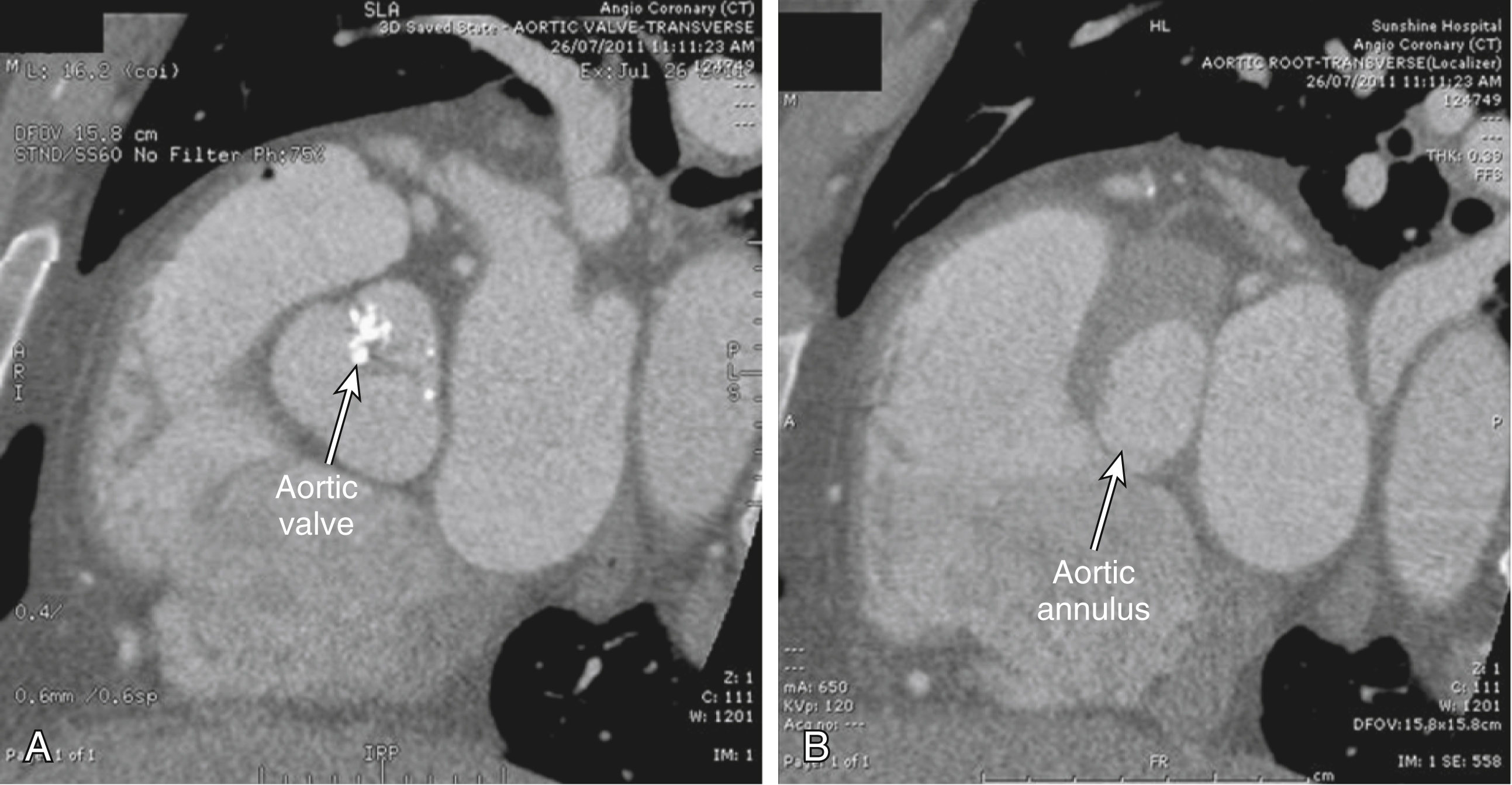 Fig. 50.7, (A) Transverse view of aortic valve. (B) Transverse view of aortic annulus reveals its oval shape.