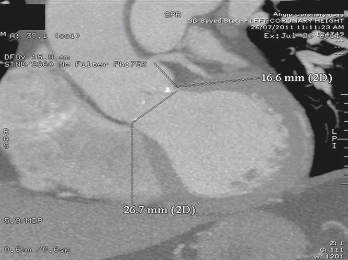 Fig. 50.8, Measurement of left coronary height from aortic annulus. 2D , Two-dimensional.