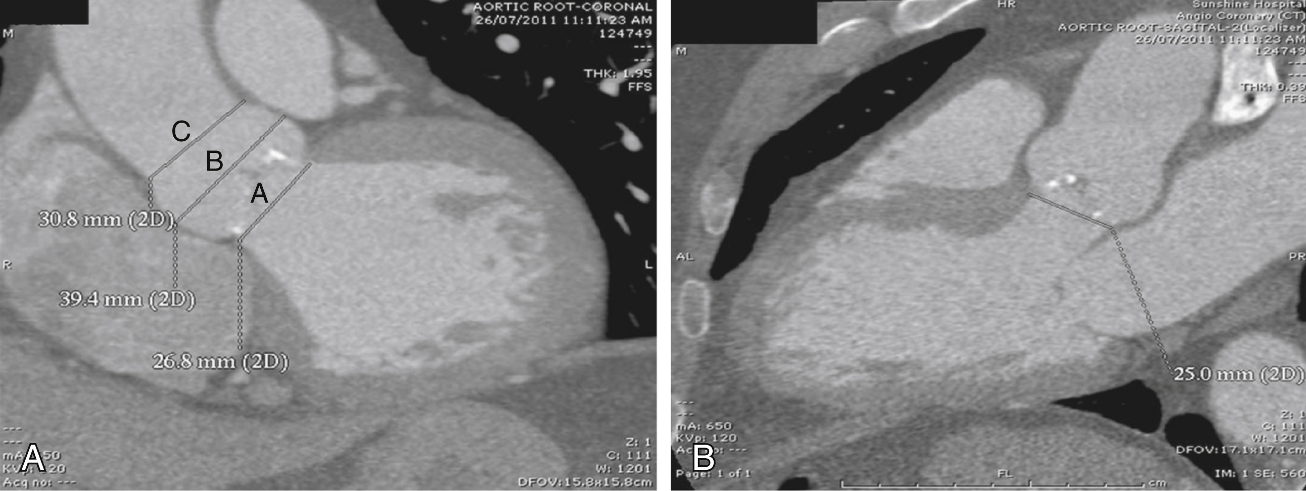 Fig. 50.9, (A) Aortic root measurements in coronal view, which is similar to left anterior oblique view on fluoroscopic working view. Letters A, B, and C correspond to aortic annular diameter, aortic sinus diameter, and sinotubular diameter, respectively. (B) Aortic annular diameter in sagittal view (corresponding to three-chamber view of echocardiography). 2D , Two-dimensional.