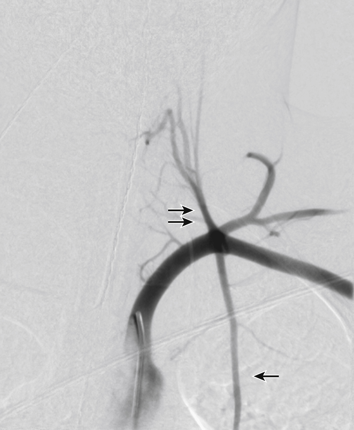 Fig. 9.3, Left subclavian artery angiogram. Note absence of left vertebral artery, which arises separately from the aortic arch (not demonstrated). Thyrocervical trunk ( double arrow ) is first branch of left subclavian artery. Single arrow points to internal thoracic artery.