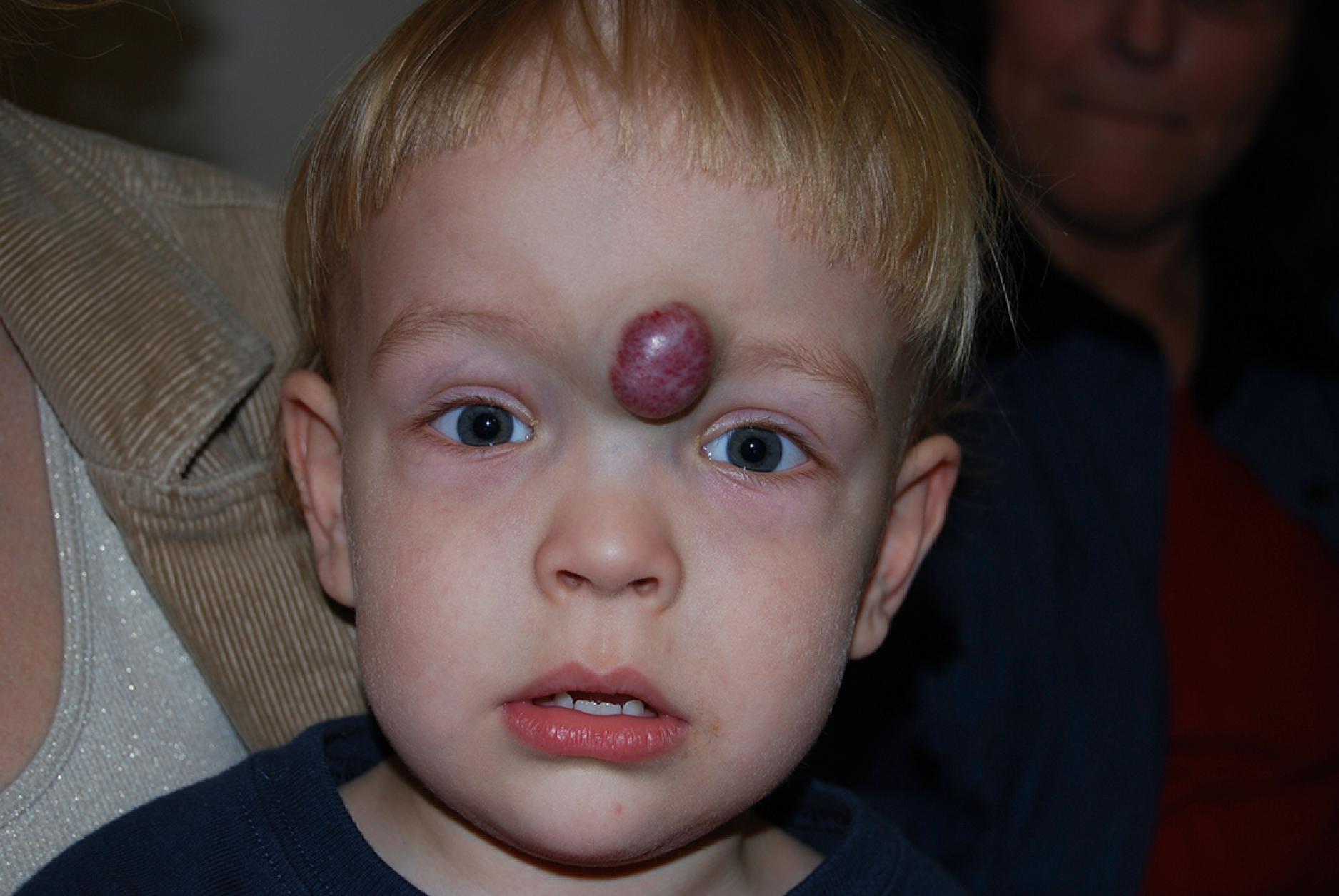 Fig. 10.1, Localized hemangioma. This facial hemangioma appears as a bulky vascular tumor with easily defined borders.