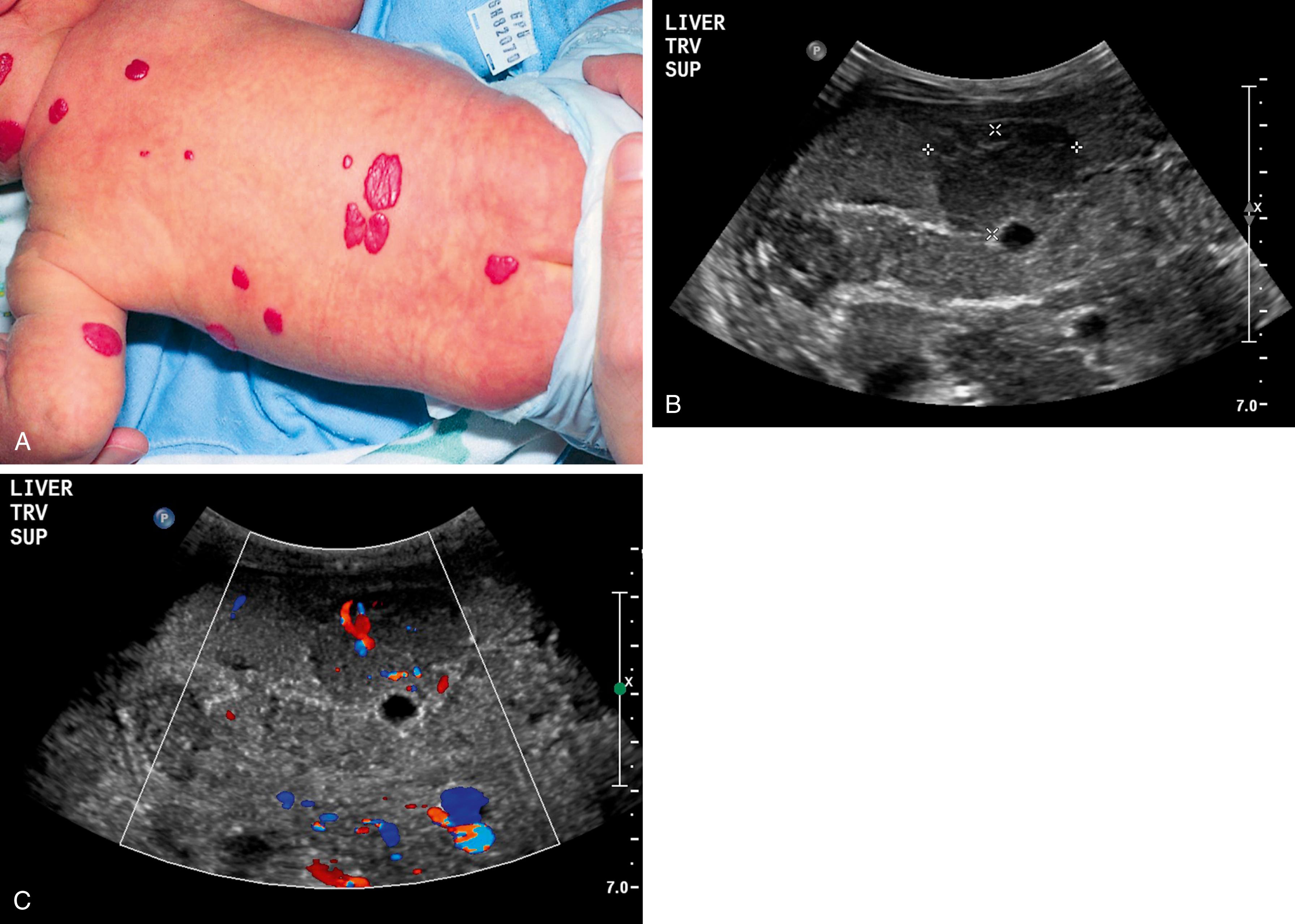 Fig. 10.11, Hemangiomatosis. (A) Multiple soft, red, raised lesions dot the back and arms of this otherwise healthy 1 month old with benign hemangiomatosis. Liver ultrasound demonstrating intrahepatic hemangioma adjacent to the portal vein (B), which on Doppler demonstrates vascular flow (C).