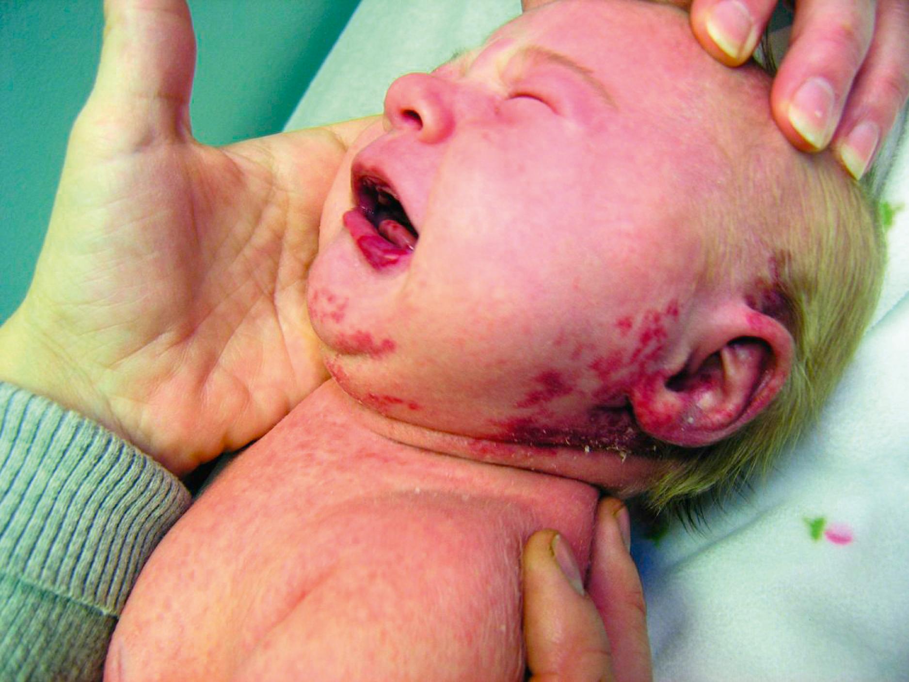 Fig. 10.12, Segmental hemangioma involving the “beard” distribution of the lower face signals the possibility of underlying airway hemangiomas.