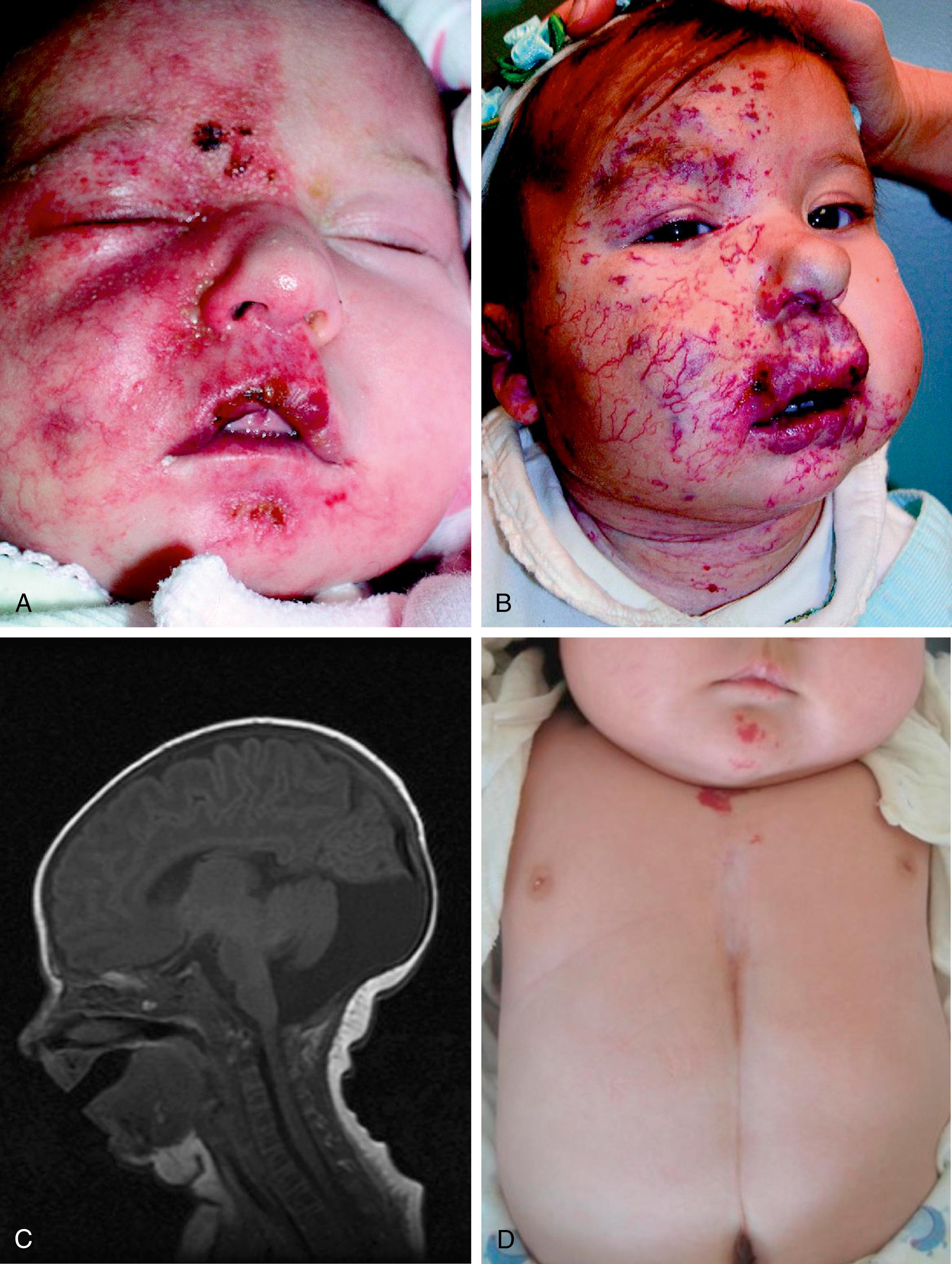 Fig. 10.13, PHACES syndrome. (A) At birth, lesions are plaque-like and may mimic a port-wine stain. (B) However, once they start to rapidly proliferate, becoming raised, as seen in the same infant at 1 year old. (C) This magnetic resonance imaging reveals a Dandy-Walker malformation in an infant with PHACES. (D) Supraumbilical raphe noted on newborn with PHACES.