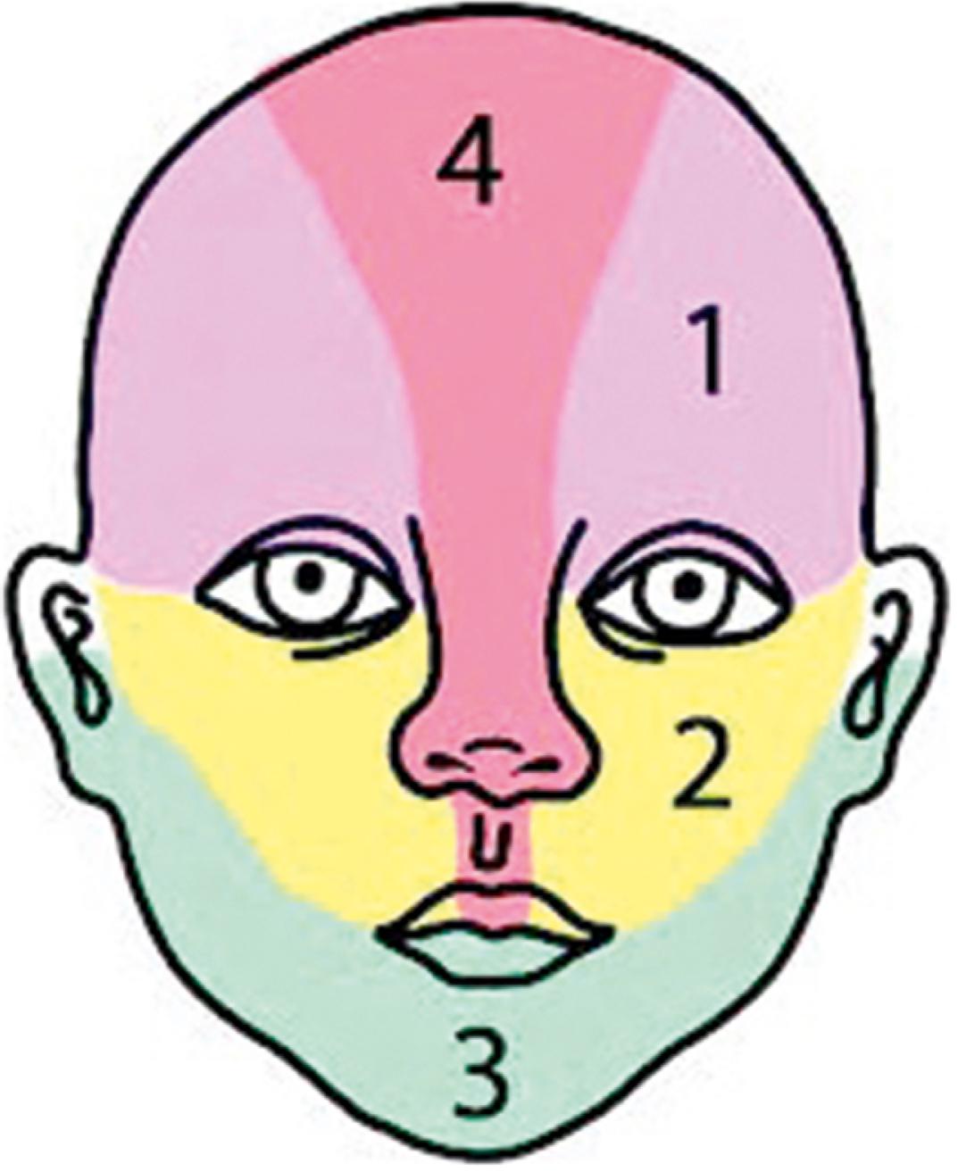 Fig. 10.14, Diagram demonstrates the different facial regions of a segmental hemangioma. The regions are not informative independently, but involvement in multiple regions increases the likelihood of the associated congenital anomalies of PHACES.