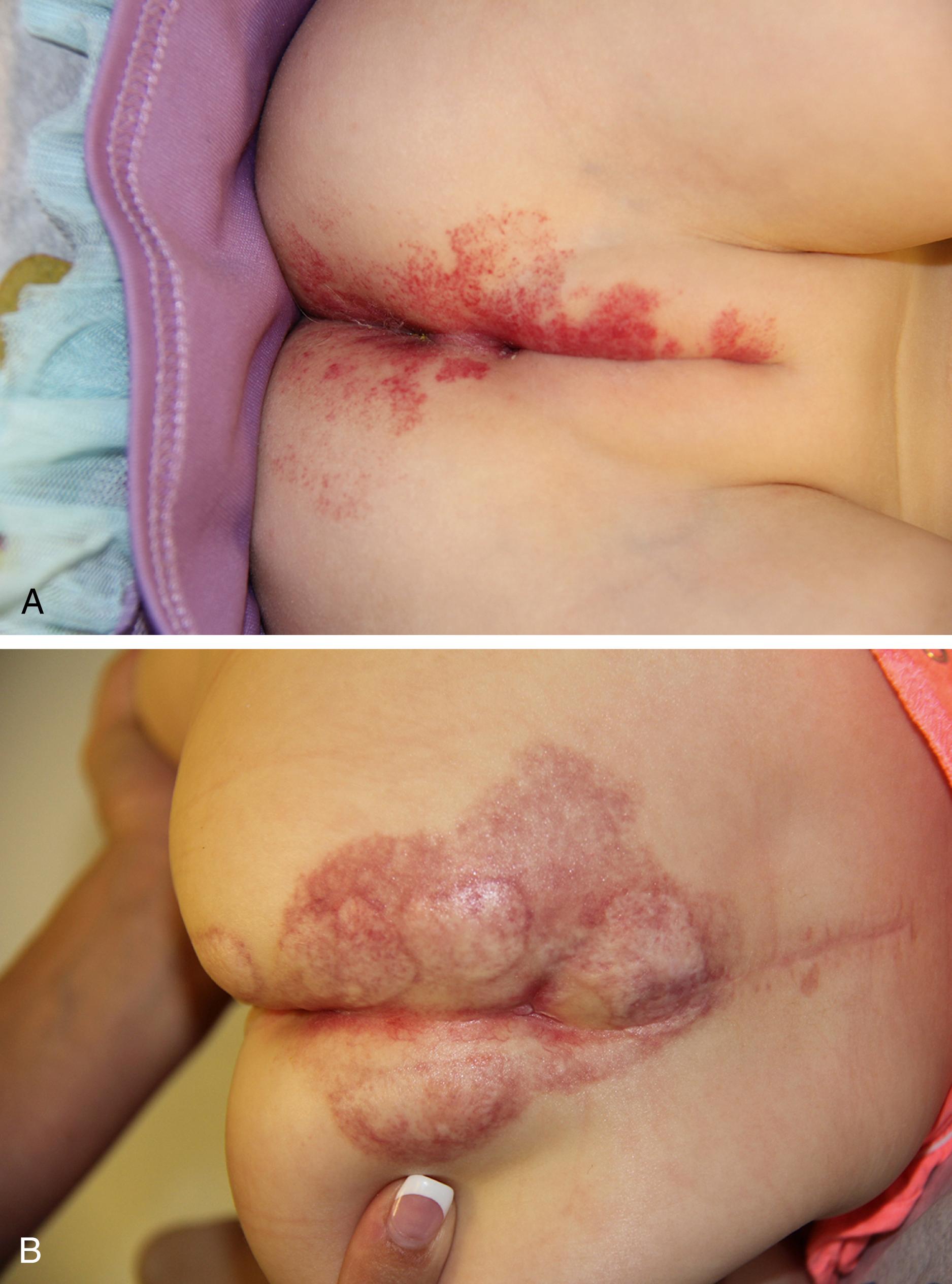 Fig. 10.15, LUMBAR syndrome. (A) A segmental hemangioma in perineum. (B) A segmental hemangioma overlying lumbar spine.