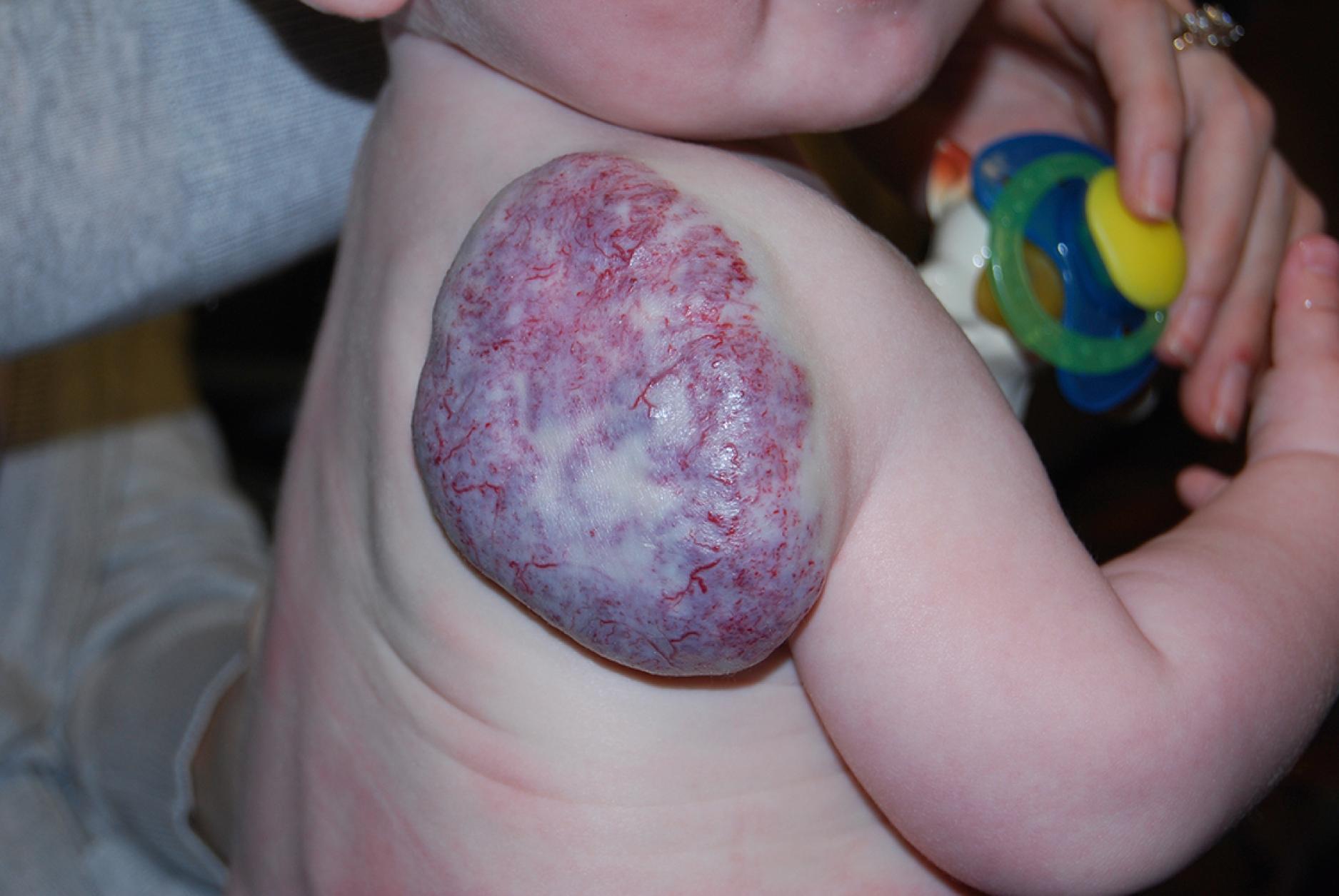 Fig. 10.16, Noninvoluting congenital hemangioma lesion. These lesions are present at birth and have telangiectatic surface surrounding by a rim of pallor.