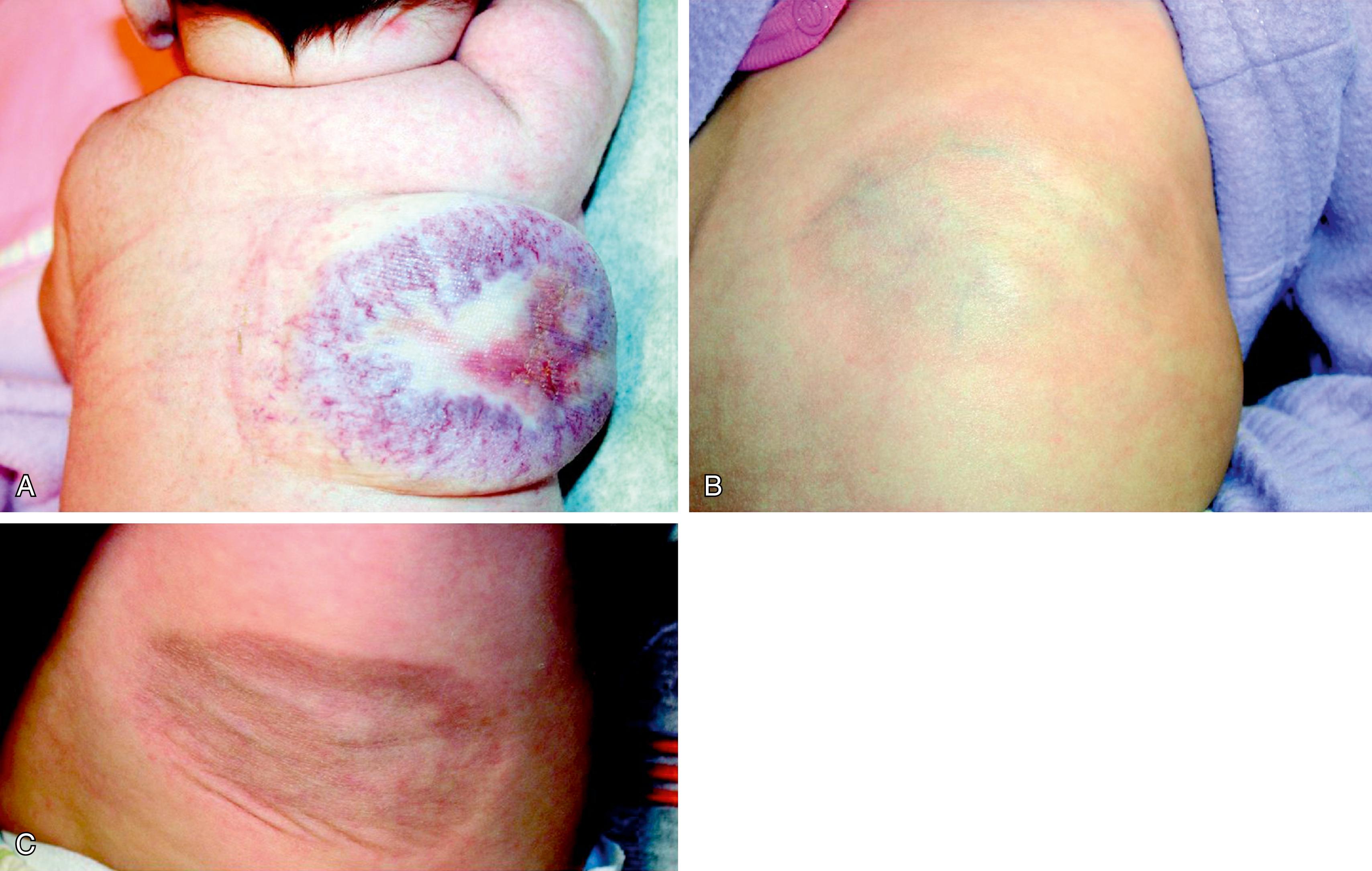 Fig. 10.17, Rapidly involuting congenital hemangioma (RICH) lesion. Also present at birth, these lesions grow no larger but instead involute rapidly and have often resolved by 1 year of age. (A) This infant has a large RICH lesion on his back, which is in the process of involution. Following involution these lesions leave behind an atrophic plaque. (B) In this child, evidence of mild residual atrophy is seen. (C) Another child was left with marked subcutaneous atrophy at the site.