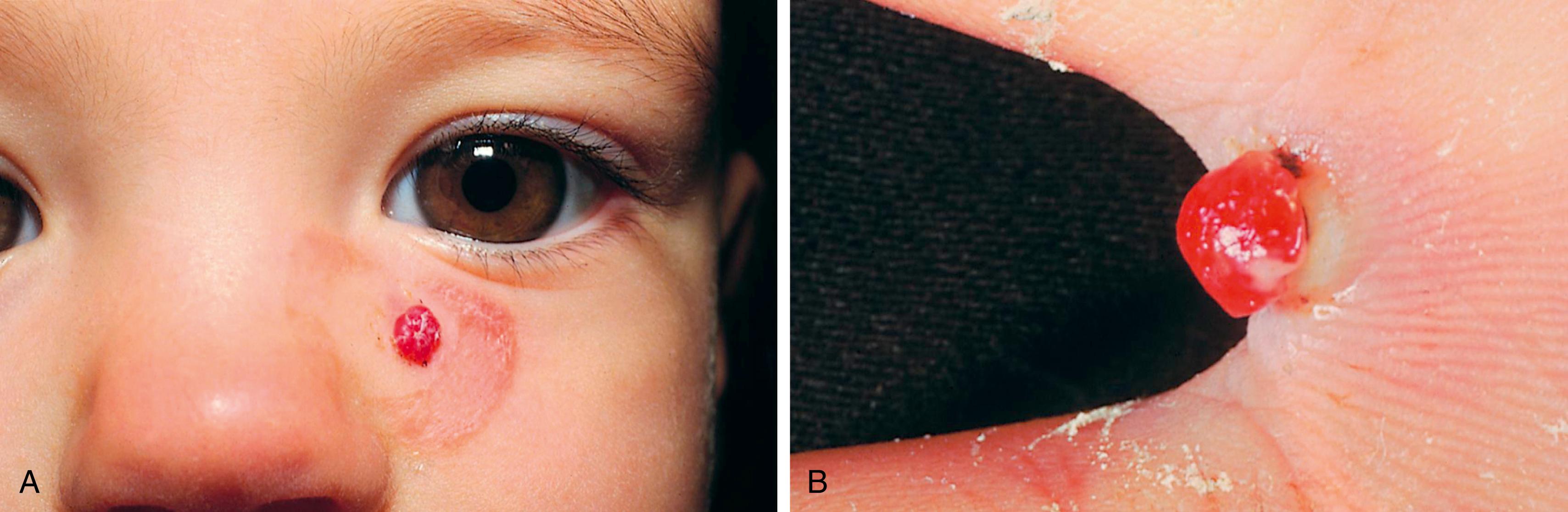 Fig. 10.18, Pyogenic granuloma. (A) A bright red, raised hemorrhagic papule developed on an infant’s cheek. (B) Another rapidly growing friable lesion is present between this child’s fingers.