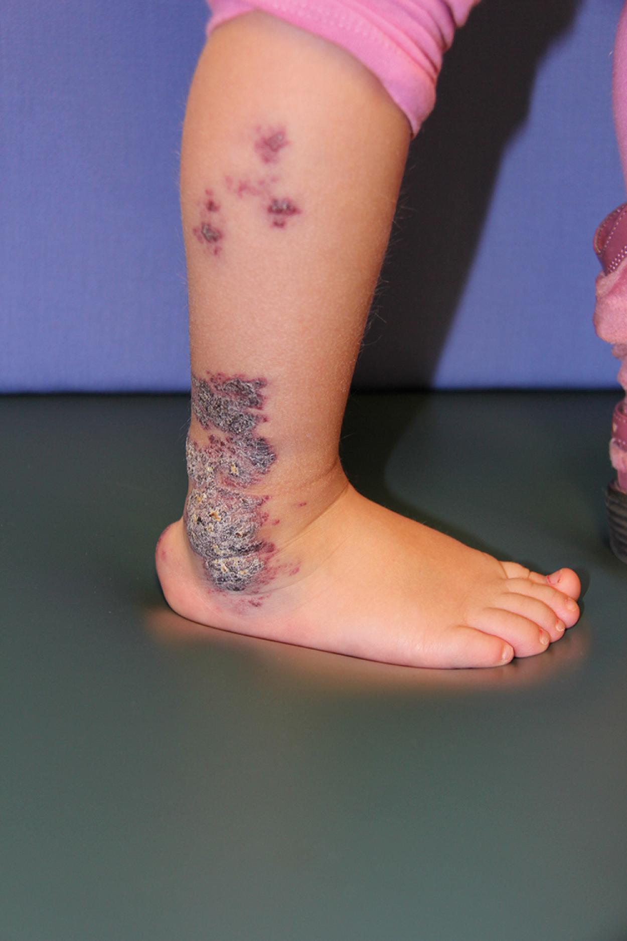 Fig. 10.19, Verrucous hemangioma. Hyperkeratotic lesion on the lateral ankle.