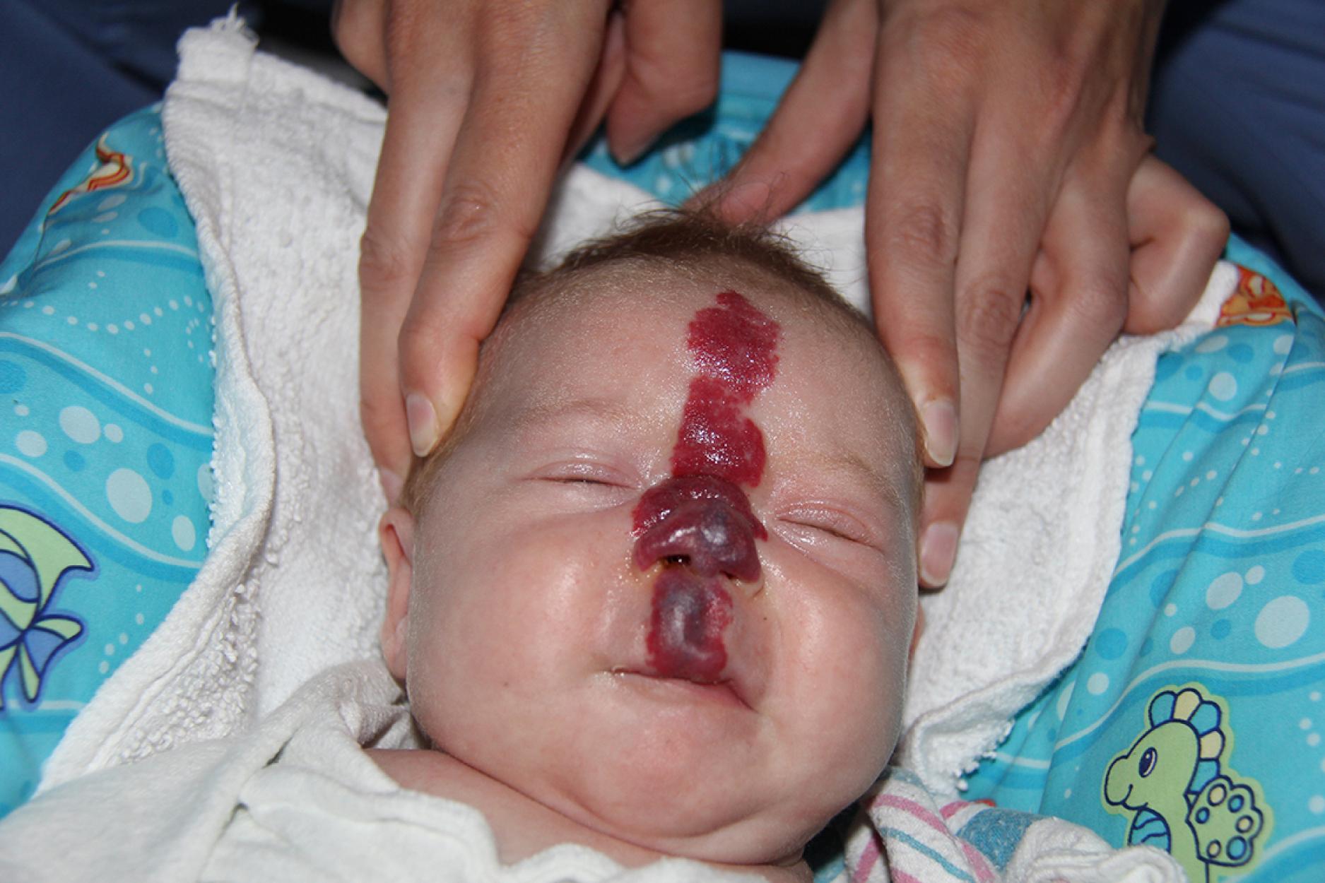 Fig. 10.2, Segmental hemangioma. This facial hemangioma appears as plaque-like lesions that seem to be contained within a pseudodermatomal distribution.