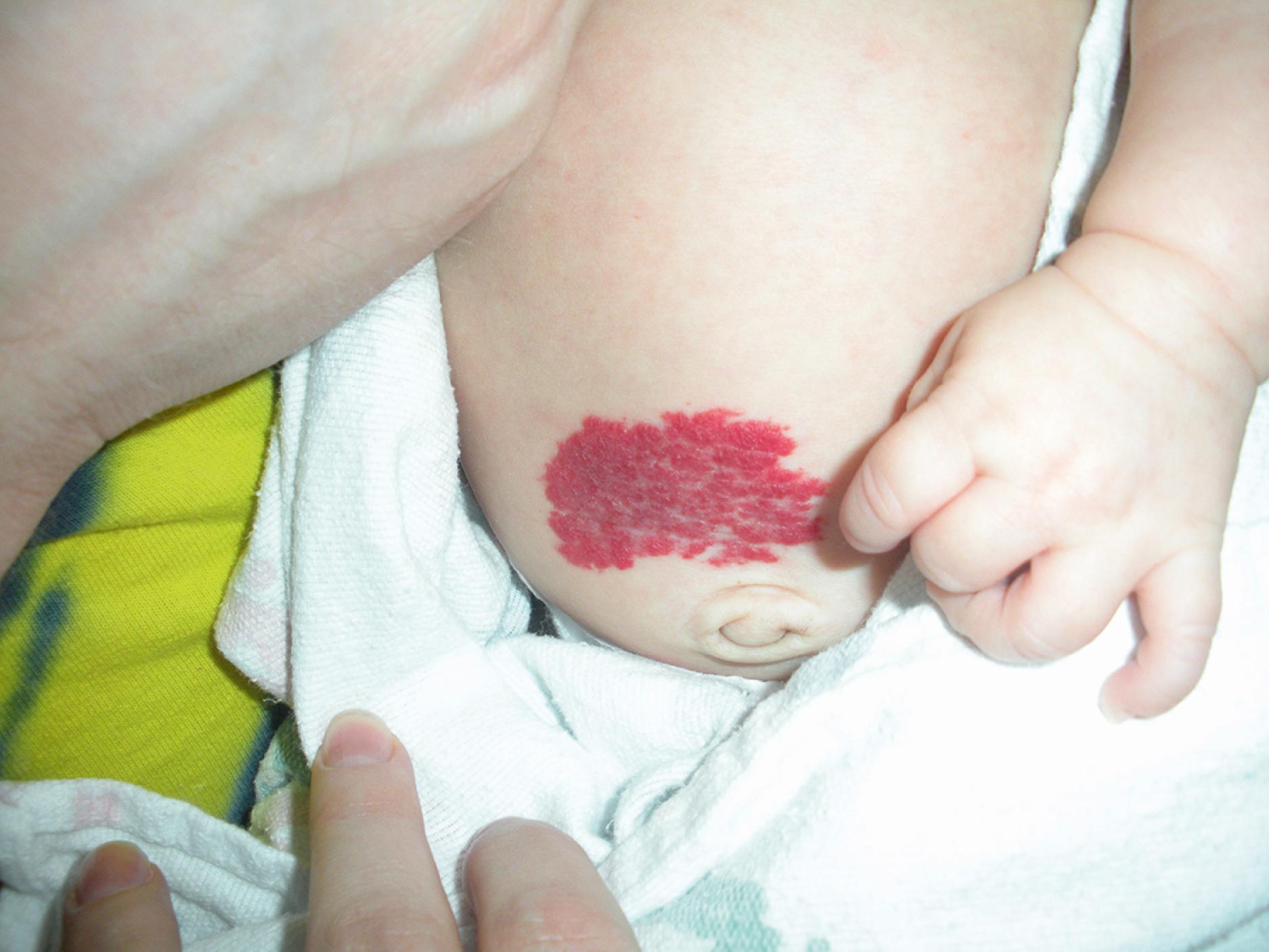 Fig. 10.3, Superficial hemangioma. This hemangioma is a confluent red plaque with the appearance that it can be pulled off the surface of the skin.