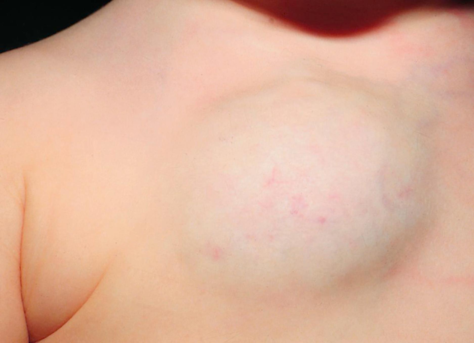 Fig. 10.4, Deep hemangioma. Most of the vessels that make up this large partially compressible mass lie deep beneath the skin surface but still impart a bluish hue to the overlying surface.