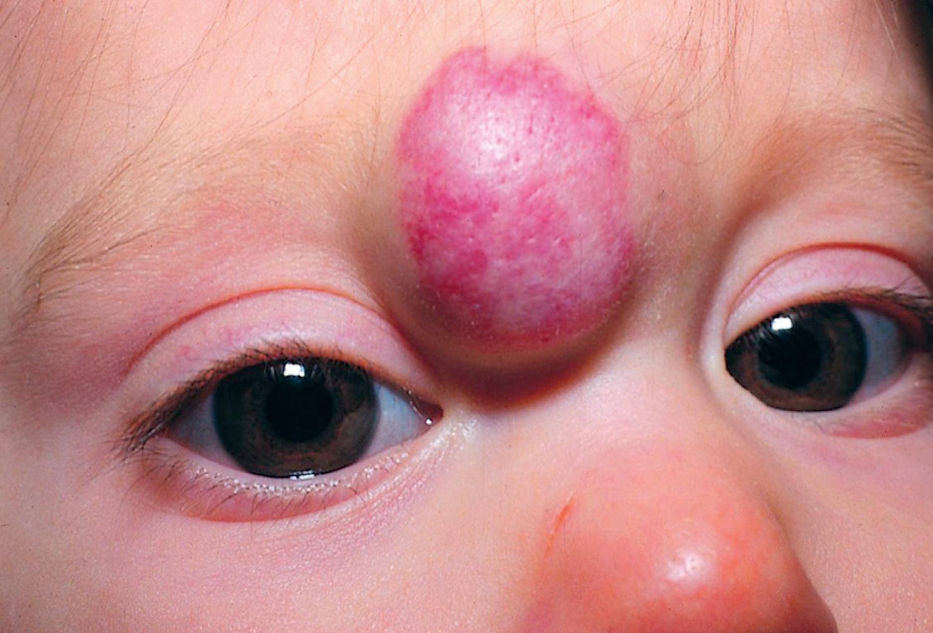 Fig. 10.5, Mixed hemangioma. The hemangioma on this child’s nasal bridge has both a superficial and deep component.