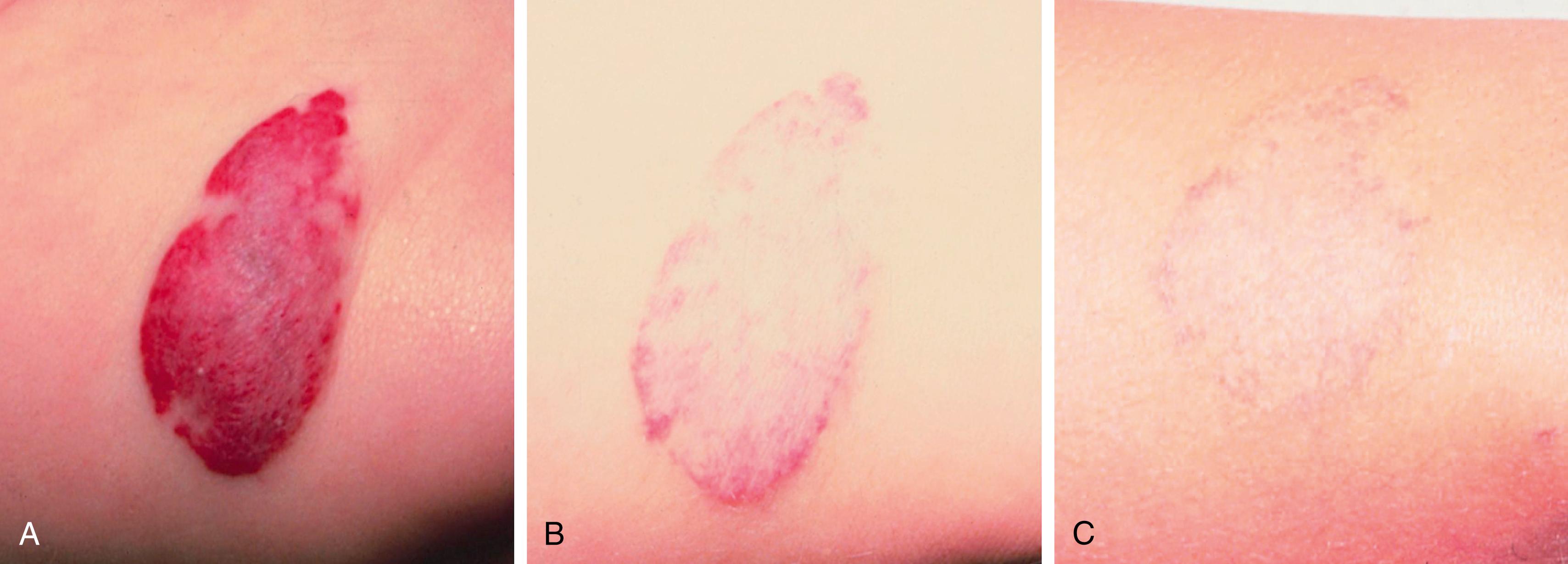 Fig. 10.6, Natural history of hemangioma. After growing for approximately 6 months, hemangiomas tend to plateau in size and then gradually involute. The appearance at 5 months old (A), at 2 years old (B), and almost total resolution at 5 years old (C).