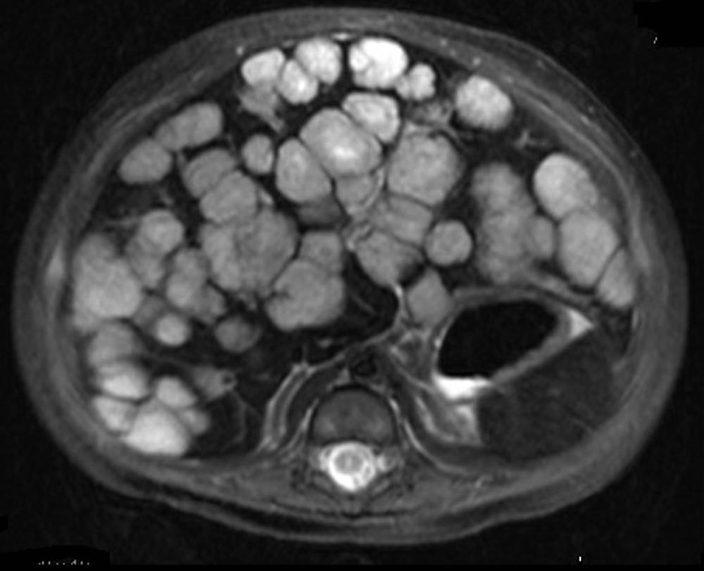 Fig. 10.7, Multifocal hepatic infantile hemangioma identified as well-circumscribed, densely lobulated mass with moderately hyperintense signal on T2-weighted axial images.