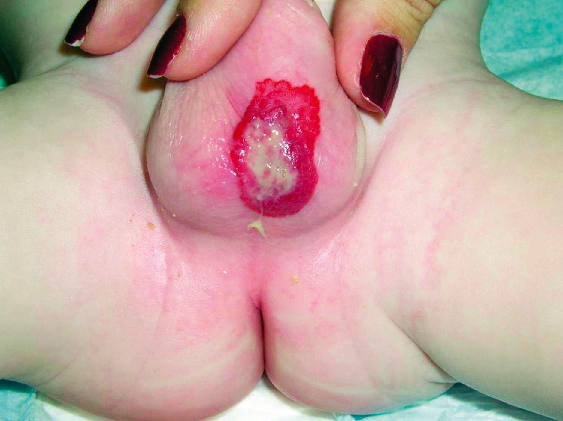 Fig. 10.8, Ulcerated hemangioma. Hemangiomas located in friction- or maceration-prone areas are at risk for ulceration. When ulcerated, they cause significant pain and are vulnerable to infection, and, ultimately, scarring unless treated aggressively.