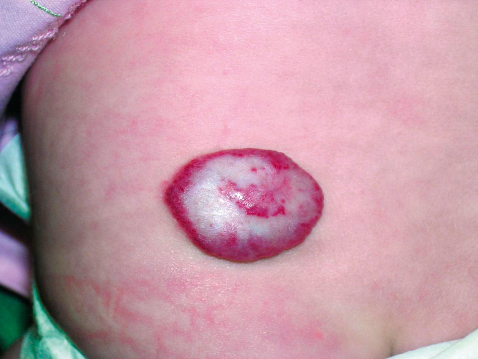 Fig. 10.9, Involuting hemangioma. The onset of involution is signaled by a “graying out” of the surface of the lesion. When this occurs during the rapid proliferation stage, it signals impending ulceration.