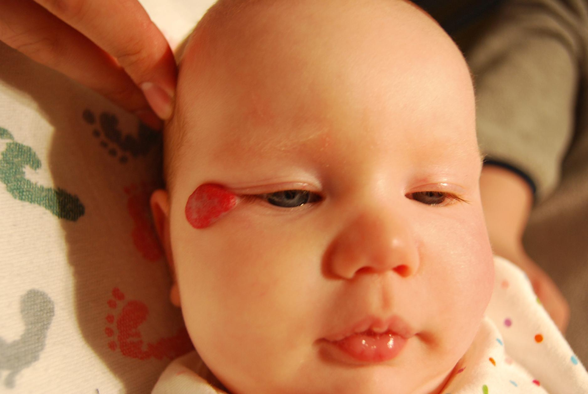 Fig. 10.10, Periorbital hemangioma. Localized hemangioma located at the lateral epicanthus of the eye.